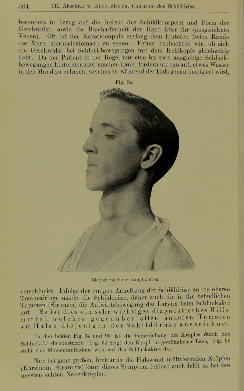 besonders in bezug auf die Inzisur des Schildknarpels) und Form der Geschwulst, sowie die Beschaffenheit der Haut über ihr (ausgedehnte Venen). Oft ist der Karotidenpuls entlang dem hinteren freien Rande des Muse, sternocleidomast. zu sehen. Ferner beobachten wir, ob sich die Geschwulst bei Schluckbewegungen mit dem Kehlkopfe gleichzeitig hebt. Da der Patient in der Regel nur eine bis zwei ausgiebige Schluck- bewegungen hintereinander machen kann, fordern wir ihn auf, etwas Wasser in den Mund zu nehmen, welches er, während der Hals genau inspiziert wird, Fig. 94. Kleiner medianer Kropfknoten. verschluckt. Infolge der innigen Anheftung der Schilddrüse an die oberen Trachealringe macht die Schilddrüse, daher auch die in ihr befindlichen Tumoren (Strumen) die Aufwärtsbewegung des Larynx beim Schluckakte mit. Es ist dies ein sehr wichtiges diagnostisches Hilfs- mittel, welches gegenüber allen anderen Tumoren a m H a 1 s e diejenigen der Schilddrüse auszeichnet. ln den beiden Fig. 94 und 95 ist die Verschiebung des Kropfes durch den Schluckakt demonstriert. Fig. 94 zeigt den Kropf in gewöhnlicher Lage, Fig. 95 stellt eine Momentaufnahme während des Schluckaktes dar. Nur bei ganz großen, brettartig die Halswand infiltrierenden Kröpfen (Karzinom, Strumitis) kann dieses Symptom fehlen; auch fehlt es bei den meisten echten Nebenkröpfen.
