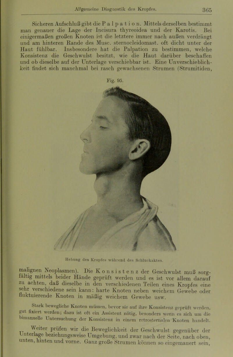 Sicheren Aufschluß gibt die Palpation. Mittels derselben bestimmt man genauer die Lage der Incisura thyreoidea und der Karotis. Bei einigermaßen großen Knoten ist die letztere immer nach außen verdrängt und am hinteren Rande des Muse, sternocleidomast. oft dicht unter der Haut fühlbar. Insbesondere hat die Palpation zu bestimmen, welche Konsistenz die Geschwulst besitzt, wie die Haut darüber beschaffen und ob dieselbe auf der Unterlage verschiebbar ist. Eine Unverschieblich- keit findet sich manchmal bei rasch gewachsenen Strumen (Strumitiden, Fig. 95. Hebung des Kropfes während des Schluckaktes. malignen Neoplasmen). Die Konsistenz der Geschwulst muß sorg- fältig mittels beider Hände geprüft werden und es ist vor allem darauf zu achten, daß dieselbe in den verschiedenen Teilen eines Kropfes eine sehr verschiedene sein kann: harte Knoten neben weichem Gewebe oder fluktuierende Knoten in mäßig weichem Gewebe usw. Stark bewegliche Knoten müssen, bevor sie auf ihre Konsistenz geprüft werden, „ut fixkrt werden; dazu ist oft ein Assistent nötig, besonders wenn es sich um die bi manuelle Untersuchung der Konsistenz in einem retrosternalen Knoten handelt. tt ^ eitcr prüfen wir die Beweglichkeit der Geschwulst gegenüber der Unterlage beziehungsweise Umgebung, und zwar nach der Seite, nach oben, un en, mten und vorne. Ganz große Strumen können so eingemauert sein,