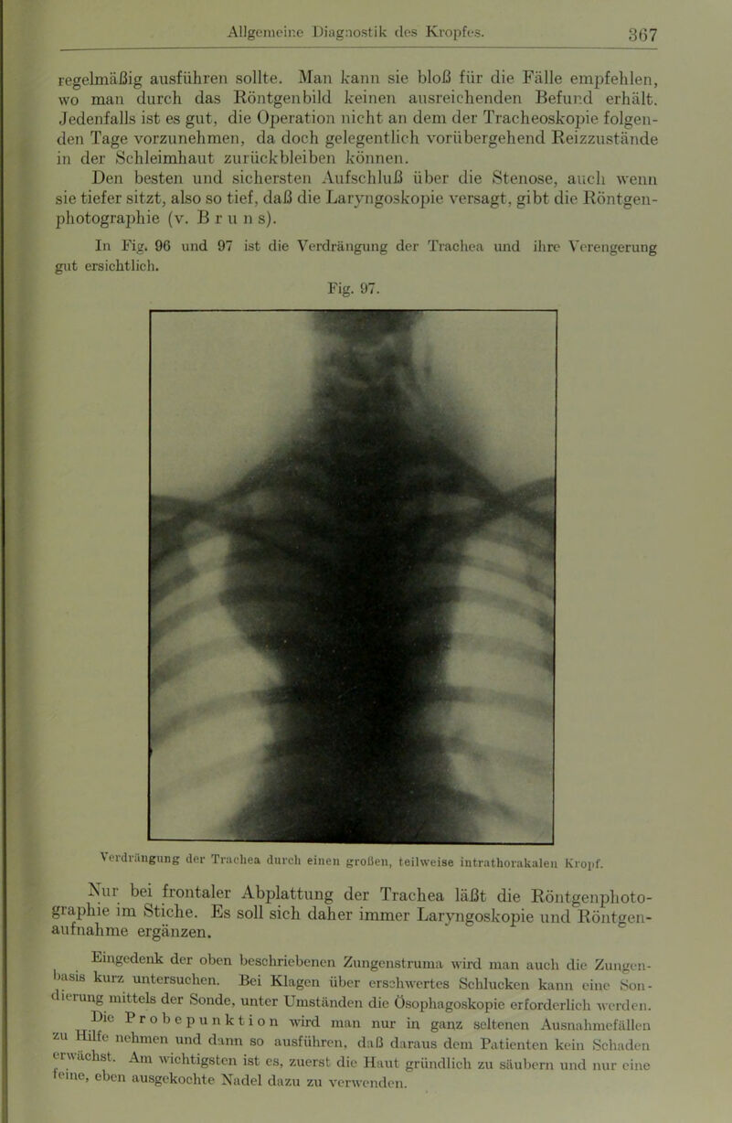 regelmäßig ausführen sollte. Man kann sie bloß für die Fälle empfehlen, wo man durch das Röntgenbild keinen ausreichenden Befund erhält. Jedenfalls ist es gut, die Operation nicht an dem der Tracheoskopie folgen- den Tage vorzunehmen, da doch gelegentlich vorübergehend Reizzustände in der Schleimhaut Zurückbleiben können. Den besten und sichersten Aufschluß über die Stenose, auch wenn sie tiefer sitzt, also so tief, daß die Laryngoskopie versagt, gibt die Röntgen- photographie (v. B r u n s). In Fig. 96 und 97 ist die Verdrängung der Trachea und gut ersichtlich. Fig. 97. ihre Verengerung Verdrängung der Trachea durch einen großen, teilweise intrathorakalen Kroi>f. Aui bei frontaler Abplattung der Trachea läßt die Röntgenphoto- graphie im Stiche. Es soll sich daher immer Laryngoskopie und Röntgen- aufnahme ergänzen. Eingedenk der oben beschriebenen Zungenstruma wird man auch die Zungen- basiu kurz untersuchen. Bei Klagen über erschwertes Schlucken kann eine Son- ierung mittels der Sonde, unter Umständen die Ösophagoskopie erforderlich werden. Die Probepunktion wird man nur in ganz seltenen Ausnahmefällen zu Hilfe nehmen und dann so ausführen, daß daraus dem Patienten kein Schaden erwächst. Am wichtigsten ist es, zuerst die Haut gründlich zu säubern und nur eine t me, eben ausgekochte Nadel dazu zu verwenden.