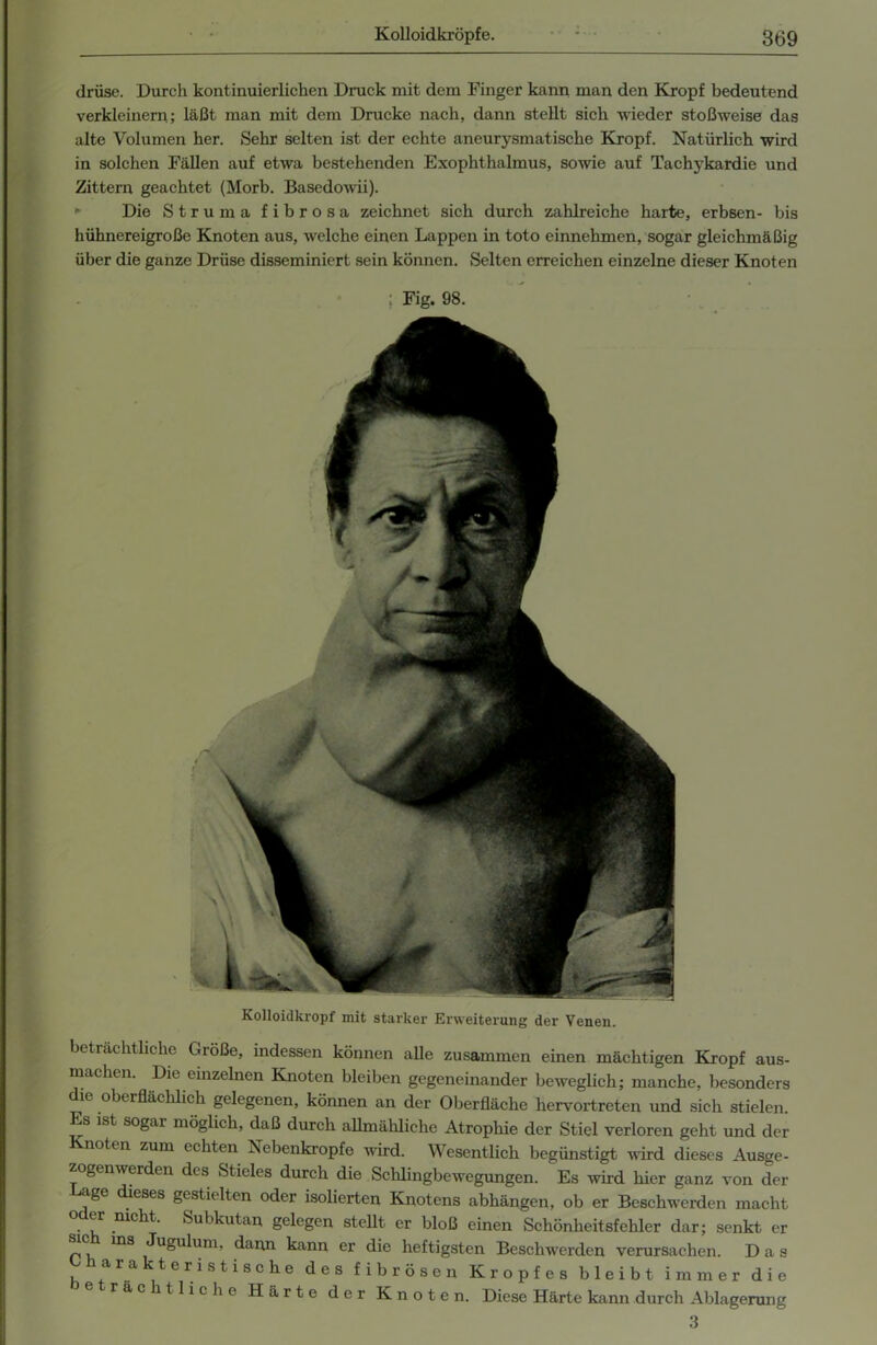 drüse. Durch kontinuierlichen Druck mit dem Finger kann man den Kropf bedeutend verkleinern; läßt man mit dem Drucke nach, dann stellt sich wieder stoßweise das alte Volumen her. Sehr selten ist der echte aneurysmatische Kropf. Natürlich wird in solchen Fällen auf etwa bestehenden Exophthalmus, sowie auf Tachykardie und Zittern geachtet (Morb. Basedowii). Die Struma fibrosa zeichnet sich durch zahlreiche harte, erbsen- bis hühnereigroße Knoten aus, welche einen Lappen in toto einnehmen, sogar gleichmäßig über die ganze Drüse disseminiert sein können. Selten erreichen einzelne dieser Knoten Kolloidkropf mit starker Erweiterung der Venen. beträchtliche Größe, indessen können alle zusammen einen mächtigen Kropf aus- machen. Die einzelnen Knoten bleiben gegeneinander beweglich; manche, besonders die oberflächlich gelegenen, können an der Oberfläche hervortreten und sich stielen. Es ist sogar möglich, daß durch allmähliche Atrophie der Stiel verloren geht und der notcn zum echten Isebenkropfe wird. Wesentlich begünstigt wird dieses Ausge- zogenwerden des Stieles durch die Schlingbewegungen. Es wird hier ganz von der age dieses gestielten oder isolierten Knotens abhängen, ob er Beschwerden macht o er nicht. Subkutan gelegen stellt er bloß einen Schönheitsfehler dar; senkt er mS Ju»llIum- daun kann er die heftigsten Beschwerden verursachen. Das a ra terist ische des fibrösen Kropfes bleibt immer die räc Gliche Härte der Knoten. Diese Härte kann durch Ablagerung 3