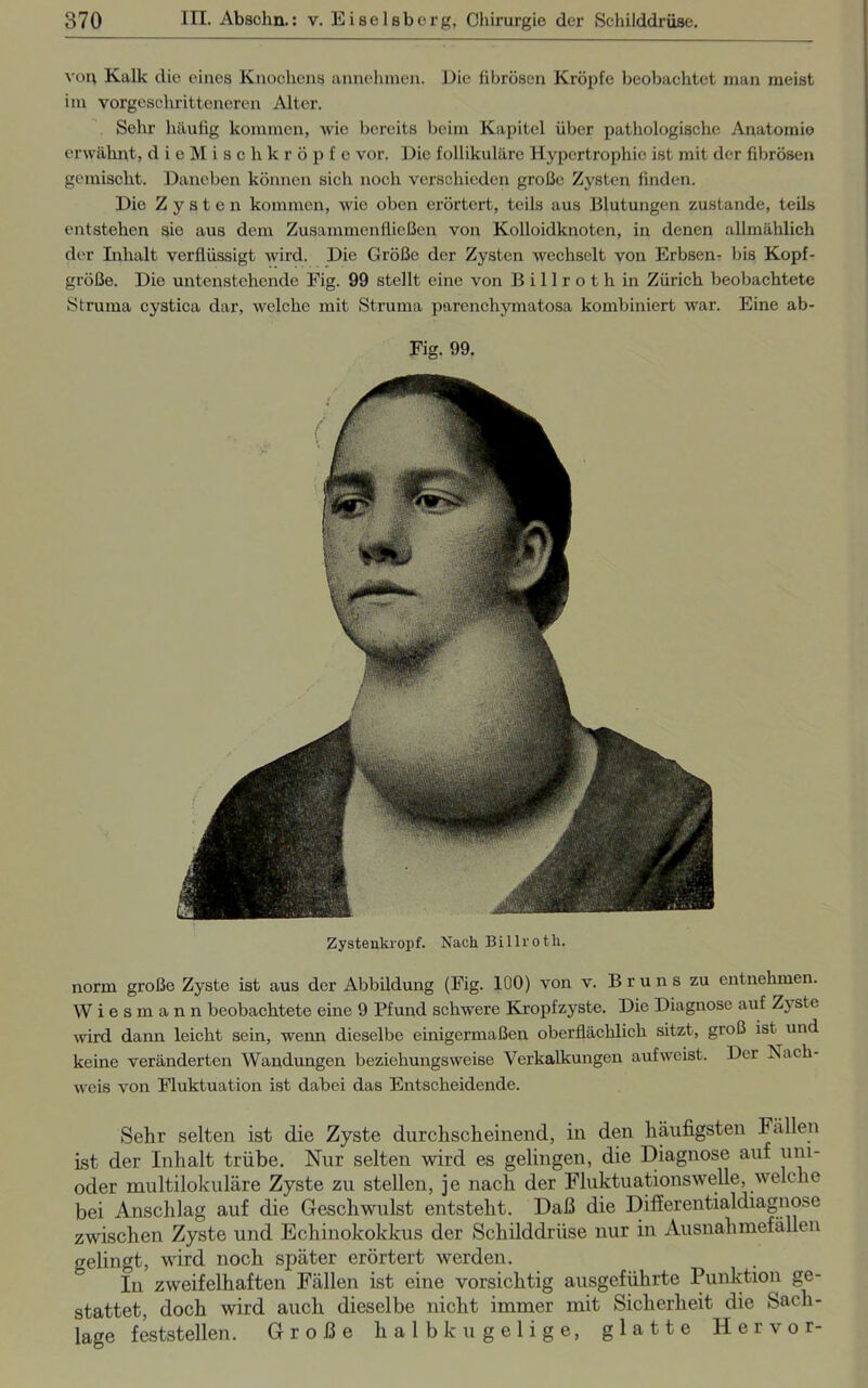 von Kalk die eines Knochens annehmen. Die fibrösen Kröpfe beobachtet man meist im vorgeschritteneren Alter. Sehr häufig kommen, wie bereits beim Kapitel über pathologische Anatomie erwähnt, dieMischkröpfe vor. Die follikuläre Hypertrophie ist mit der fibrösen gemischt. Daneben können sich noch verschieden große Zysten finden. Die Zysten kommen, wie oben erörtert, teils aus Blutungen zustande, teils entstehen sie aus dem Zusammenfließen von Kolloidknoten, in denen allmählich der Inhalt verflüssigt wird. Die Größe der Zysten wechselt von Erbsen- bis Kopf- größe. Die untenstehende Fig. 99 stellt eine von B i 11 r o t h in Zürich beobachtete Struma cystica dar, welche mit Struma parenchymatosa kombiniert war. Eine ab- Fig. 99. Zystenkropf. Nach Billroth. norm große Zyste ist aus der Abbildung (Fig. 100) von v. Bruns zu entnehmen. Wiesmann beobachtete eine 9 Pfund schwere Kropfzyste. Die Diagnose auf Zyste wird dann leicht sein, wenn dieselbe einigermaßen oberflächlich sitzt, groß ist und keine veränderten Wandungen beziehungsweise Verkalkungen aufweist. Der Nach- weis von Fluktuation ist dabei das Entscheidende. Sehr selten ist die Zyste durchscheinend, in den häufigsten Fällen ist der Inhalt trübe. Nur selten wird es gelingen, die Diagnose auf um- oder multilokulare Zyste zu stellen, je nach der Fluktuationswelle, welche bei Anschlag auf die Geschwulst entsteht. Daß die Differentialdiagnose zwischen Zyste und Echinokokkus der Schilddrüse nur in Ausnahmefällen gelingt, wird noch später erörtert werden. In zweifelhaften Fällen ist eine vorsichtig ausgeführte Punktion ge- stattet, doch wird auch dieselbe nicht immer mit Sicherheit die Sach- lage feststellen. Große halbkugelige, glatte Hervor-