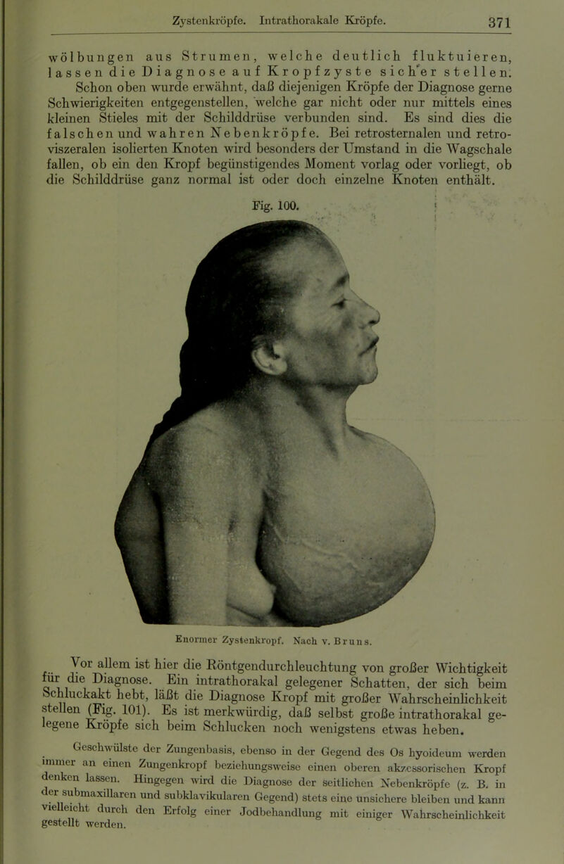 Enormer Zystenkropf. Nach v. Bruns. Y01 a^em ^ hier die Röntgendurchleuchtung von großer Wichtigkeit ür die Diagnose. Ein intrathorakal gelegener Schatten, der sich beim chluckakt hebt, läßt die Diagnose Kropf mit großer Wahrscheinlichkeit ste len (Fig. 101). Es ist merkwürdig, daß selbst große intrathorakal ge- legene Kröpfe sich beim Schlucken noch wenigstens etwas heben. Geschwülste der Zungenbasis, ebenso in der Gegend des Os hyoideum werden immer an einen Zungenkropf beziehungsweise einen oberen akzessorischen Kropf denken lassen. Hingegen wird die Diagnose der seitlichen Nebenkröpfe (z. B. in der submaxillaren und subklavikularen Gegend) stets eine unsichere bleiben und kann vielleicht durch den Erfolg einer Jodbehandlung mit einiger Wahrscheinlichkeit gestellt werden. Wölbungen aus Strumen, welche deutlich fluktuieren, lassen die Diagnose auf Kropfzyste sic Rer stellen. Schon oben wurde erwähnt, daß diejenigen Kröpfe der Diagnose gerne Schwierigkeiten entgegenstellen, welche gar nicht oder nur mittels eines kleinen Stieles mit der Schilddrüse verbunden sind. Es sind dies die falschen und wahren Nebenkröpfe. Bei retrosternalen und retro- viszeralen isolierten Knoten wird besonders der Umstand in die Wagschale fallen, ob ein den Kropf begünstigendes Moment vorlag oder vorliegt, ob die Schilddrüse ganz normal ist oder doch einzelne Knoten enthält.