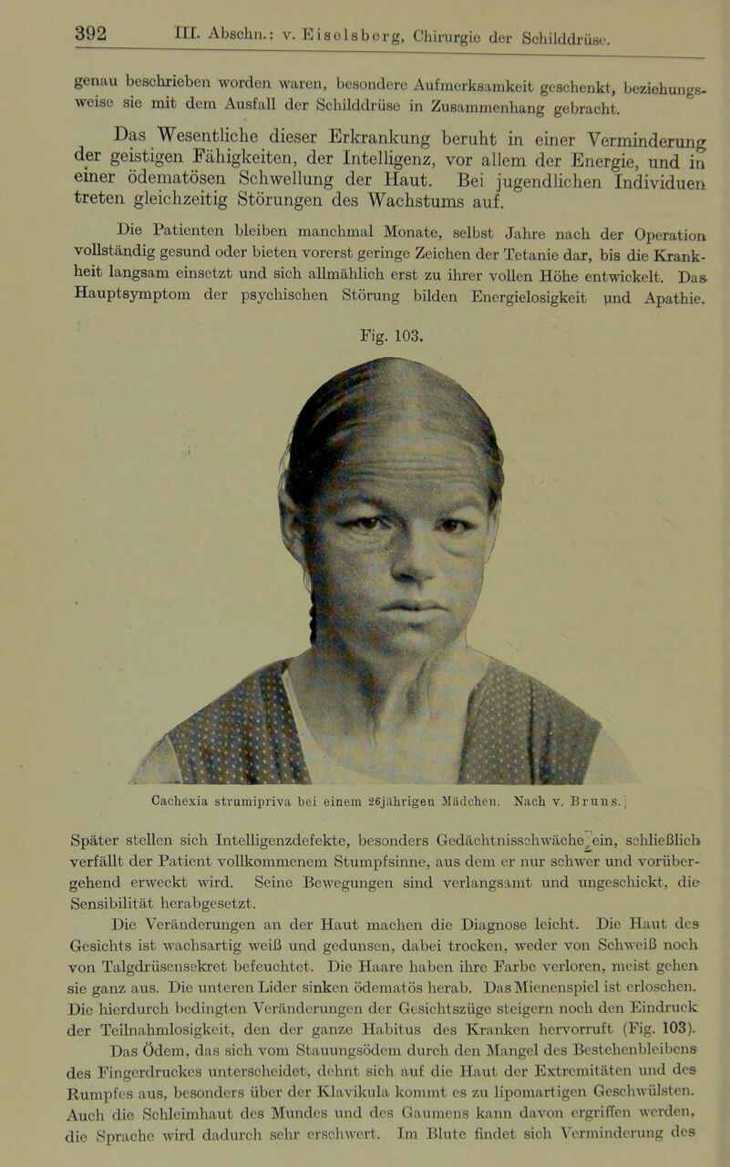 genau beschrieben worden waren, besondere Aufmerksamkeit geschenkt, beziehungs- weise sie mit dem Ausfall der Schilddrüse in Zusammenhang gebracht. Das Wesentliche dieser Erkrankung beruht in einer Verminderung der geistigen Fähigkeiten, der Intelligenz, vor allem der Energie, und in einer ödematösen Schwellung der Haut. Bei jugendlichen Individuen treten gleichzeitig Störungen des Wachstums auf. Die Patienten bleiben manchmal Monate, selbst Jahre nach der Operation vollständig gesund oder bieten vorerst geringe Zeichen der Tetanie dar, bis die Krank- heit langsam einsetzt und sich allmählich erst zu ihrer vollen Höhe entwickelt. Das Hauptsymptom der psychischen Störung bilden Energielosigkeit und Apathie. Fig. 103. Cachexia strumipriva bei einem 26jährigen Mädchen. Nach v. Bruns.; Später stellen sich Intelligenzdefekte, besonders Gedächtnisschwacherem, schließlich verfällt der Patient vollkommenem Stumpfsinne, aus dem er nur schwer und vorüber- gehend erweckt wird. Seine Bewegungen sind verlangsamt und ungeschickt, die Sensibilität herabgesetzt. Die Veränderungen an der Haut machen die Diagnose leicht. Die Haut des Gesichts ist wachsartig weiß und gedunsen, dabei trocken, weder von Schweiß noch von Talgdrüsensekret befeuchtet. Die Haare haben ihre Farbe verloren, meist gehen sie ganz aus. Die unteren Lider sinken ödematös herab. Das Mienenspiel ist erloschen. Die hierdurch bedingten Veränderungen der Gesichtszüge steigern noch den Eindruck der Teilnahmlosigkeit, den der ganze Habitus des Kranken hervorruft (Fig. 103). Das Ödem, das sich vom Stauungsödem durch den Mangel des Bestehen bleibcns des Fingerdruckes unterscheidet, dehnt sich auf die Haut der Extremitäten und des Rumpfes aus, besonders über der Klavikula kommt es zn lipomartigen Geschwülsten. Auch die Schleimhaut des Mundes und des Gaumens kann davon ergriffen werden, die Sprache wird dadurch sehr erschwert. Im Blute findet sich Verminderung des