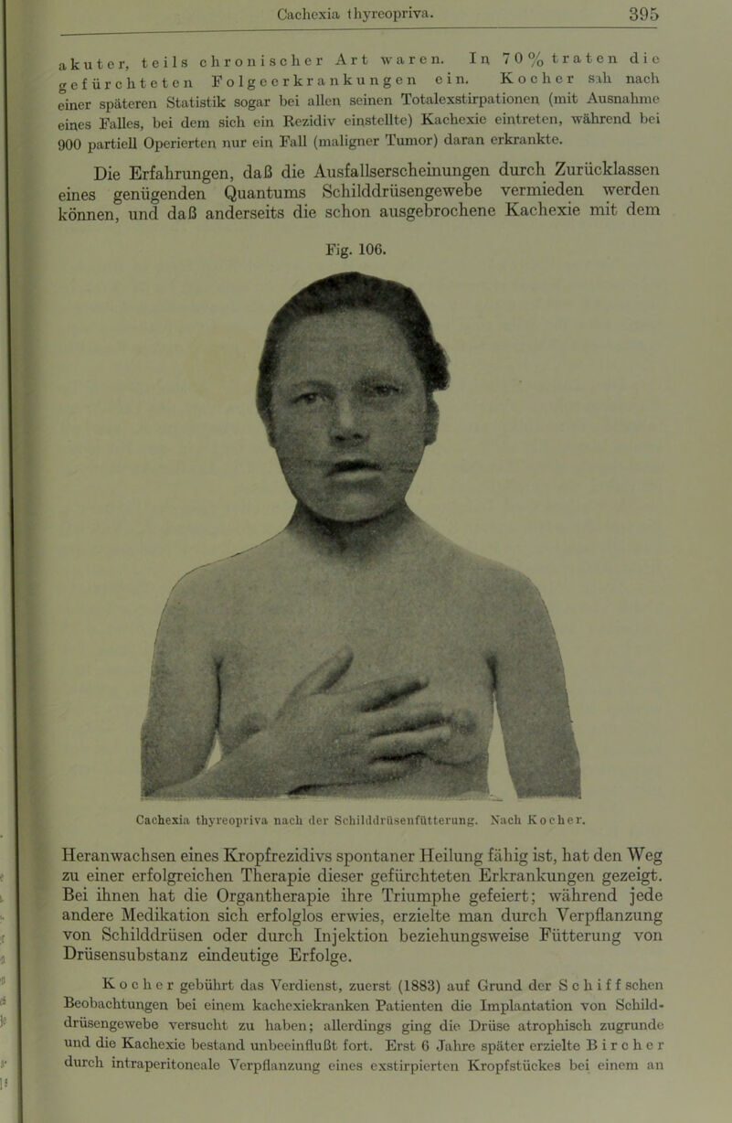 akuter, teils chronischer Art waren. In 70% traten die gefürchteten Folgeerkrankungen ein. Kocher sah nach einer späteren Statistik sogar bei allen seinen Totalexstirpationen (mit Ausnahme eines Falles, bei dem sich ein Rezidiv cinstellte) Kachexie eintreten, während bei 900 partiell Operierten nur ein Fall (maligner Tumor) daran erkrankte. Die Erfahrungen, daß die Ausfallserscheinungen durch Zurücklassen eines genügenden Quantums Schilddrüsengewebe vermieden werden können, und daß anderseits die schon ausgebrochene Kachexie mit dem Fig. 106. Cachexia thyreopriva nach (1er Schilddrüsenfütterung. Nach Kocher. Heranwachsen eines Kropfrezidivs spontaner Heilung fähig ist, hat den Weg zu einer erfolgreichen Therapie dieser gefürchteten Erkrankungen gezeigt. Bei ihnen hat die Organtherapie ihre Triumphe gefeiert; während jede andere Medikation sich erfolglos erwies, erzielte man durch Verpflanzung von Schilddrüsen oder durch Injektion beziehungsweise Fütterung von Drüsensubstanz eindeutige Erfolge. Kocher gebührt das Verdienst, zuerst (1883) auf Grund der Schiff sehen Beobachtungen bei einem kachexiekranken Patienten die Implantation von Schild- drüsengewebe versucht zu haben; allerdings ging die Drüse atrophisch zugrunde und die Kachexie bestand unbeeinflußt fort. Erst 6 Jahre später erzielte Bircher durch intraperitoneale Verpflanzung eines exstirpierten Kropfstückes bei einem an