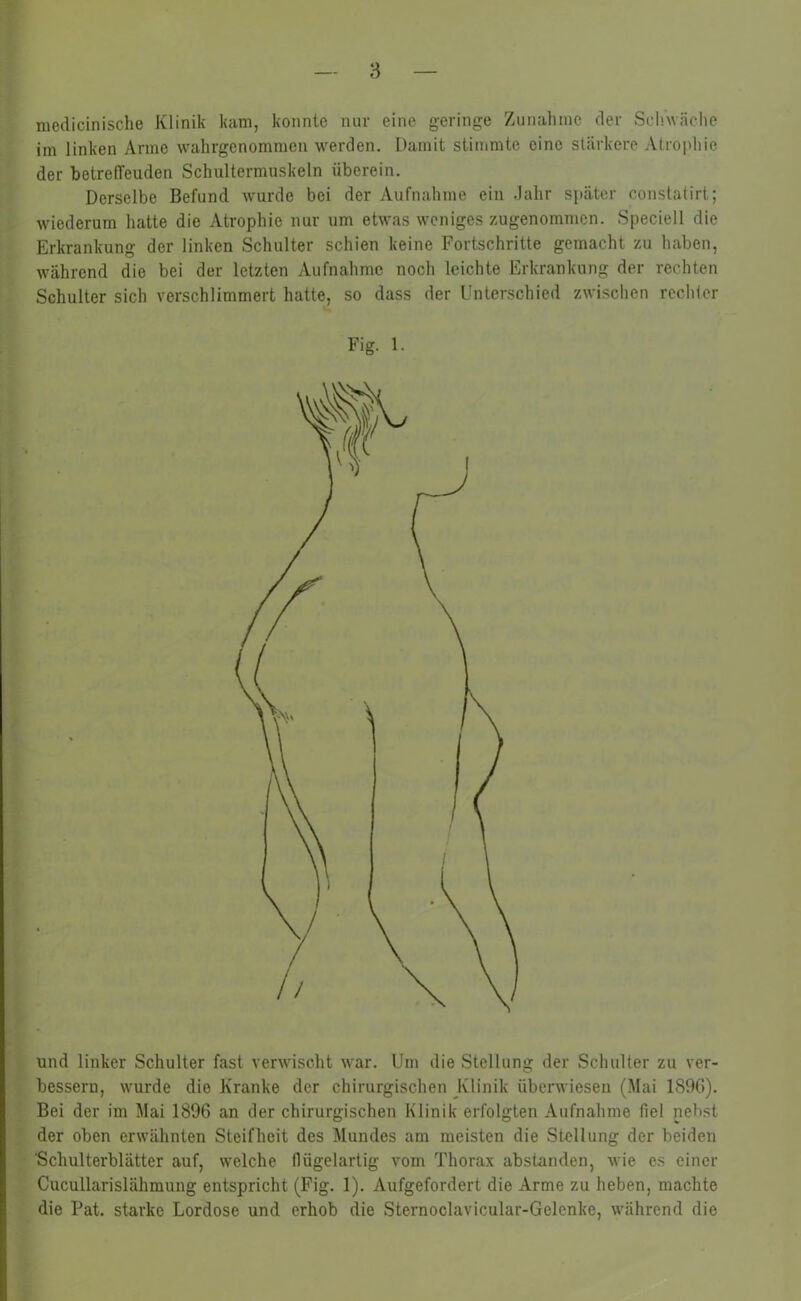 medicinische Klinik kam, konnte nur eine geringe Zunahme der Schwäche im linken Anne wahrgenommen werden. Damit stimmte eine stärkere Atrophie der hetrelTeuden Schultermuskeln überein. Derselbe Befund wurde bei der Aufnahme ein Jahr später constatirt; wiederum hatte die Atrophie nur um etwas weniges zugenommen. Speciell die Erkrankung der linken Schulter schien keine Fortschritte gemacht zu haben, wahrend die bei der letzten Aufnahme noch leichte Erkrankung der rechten Schulter sich verschlimmert hatte, so dass der Unterschied zwischen rechier Fig. 1. bessern, wurde die Kranke der chirurgischen Klinik überwiesen (Mai 1S96). Bei der im Mai 1896 an der chirurgischen Klinik erfolgten Aufnahme fiel nebst der oben erwähnten Steifheit des Mundes am meisten die Stellung der beiden Schulterblätter auf, welche flügelartig vom Thorax abstanden, wie es einer Cucullarislähmung entspricht (Fig. 1). Aufgefordert die Arme zu heben, machte die Fat. starke Lordose und erhob die Sternoclavicular-Gelenke, während die
