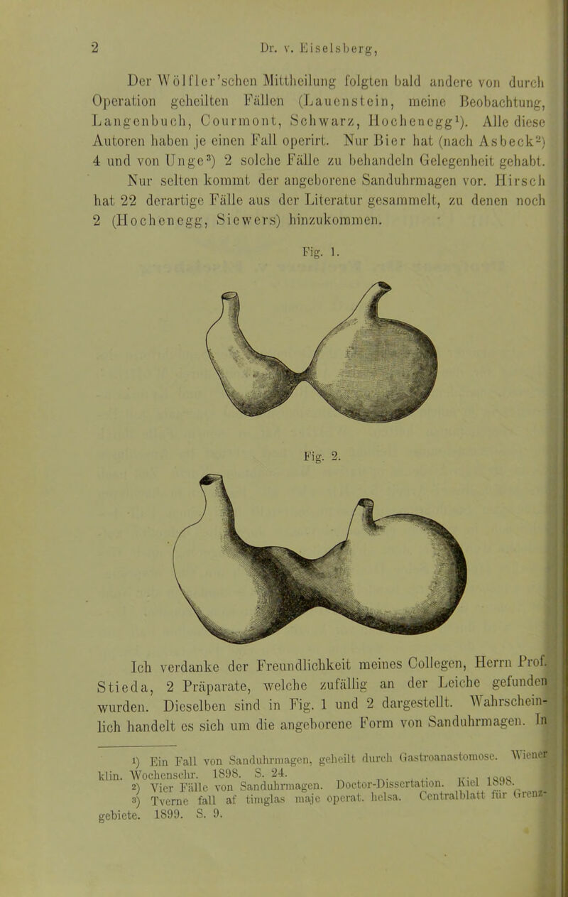 Der Wölfler’schcn Mitihcilung folgten bald andere von durcli Operation gelieilten Fällen (Lauenstein, meine Beobachtung, Langenbuch, Courmont, Schwarz, llocheneggO. Alle diese Autoren haben je einen Fall operirt. Nur Bier hat (nach Asbeck^) 4 und von UngeO 2 solche Fälle zu behandeln Gelegenheit gehabt. Nur selten kommt der angeborene Sanduhrmagen vor. Hirsch hat 22 derartige Fälle aus der Literatur gesammelt, zu denen noch 2 (tlochcncgg, Siewers) hinzukommen. Fig. 1. Ich verdanke der Freundlichkeit meines Oollegen, Herrn Biof. Stieda, 2 Präparate, welche zufällig an der Leiche gefunden wurden. Dieselben sind in Fig. 1 und 2 dargestellt. Wahrschein- lich handelt es sich um die angeborene Form von Sanduhrmagen. In 1) Ein Fall von Sandnhrmagen, geheilt durcli (iastroanastoniosc. ^^iencr klin. Wochenschr. 1898. S. 24. 1 21 Vier Fälle von Sanduhrmagen. Doctor-Dissertation. luel i 3) Tverne fall af timgla,s maje operat. heisa. Ccntralhlatt für (rrenz- gebiete. 1899. S. 9.