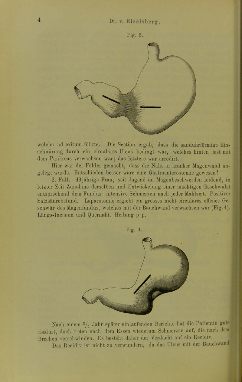 m i Fig. 3. T 1 welche ad exilum führte. Die Section ergab, dass die sanduhrförmige Ein- Hi Schnürung durch ein circulares Ulcus bedingt war, welches hinten fest mit H; dem Pankreas verwachsen war; das letztere war arrodirt. H| Hier war der Fehler gemacht, dass die Naht in kranker Magenwand an- H| gelegt wurde. Entschieden besser w.äre eine Gastroenterostomie gewesen! H; 2. Fall. 49jährige Frau, seit Jugend an Magenbeschwerden leidend, in Hi letzter Zeit Zunahme derselben und Entwickelung einer mächtigen Geschwulst entsprechend dem Fundus: intensive Schmerzen nach jeder Mahlzeit. Positiver H| Salzsäurebefund. Laparotomie ergiebt ein grosses nicht circulares offenes Ge- H^l schwür des Magenfundus, welches mit der Bauchwand verwachsen war (Fig. 4). H| Längs-Incision und Quernaht. Heilung p.p. Fig. 4. ■ Nach einem ^4 später einlaufenden Berichte hat die Patientin gute^H Esslust, doch treten nach dem Essen wiederum Schmerzen auf, die nach dem^H Brechen verschwinden. Es besteht daher der Verdacht auf ein Recidiv. ^H| Das Recidiv ist nicht zu verwundern, da das Ulcus mit der Bauchwand^^g