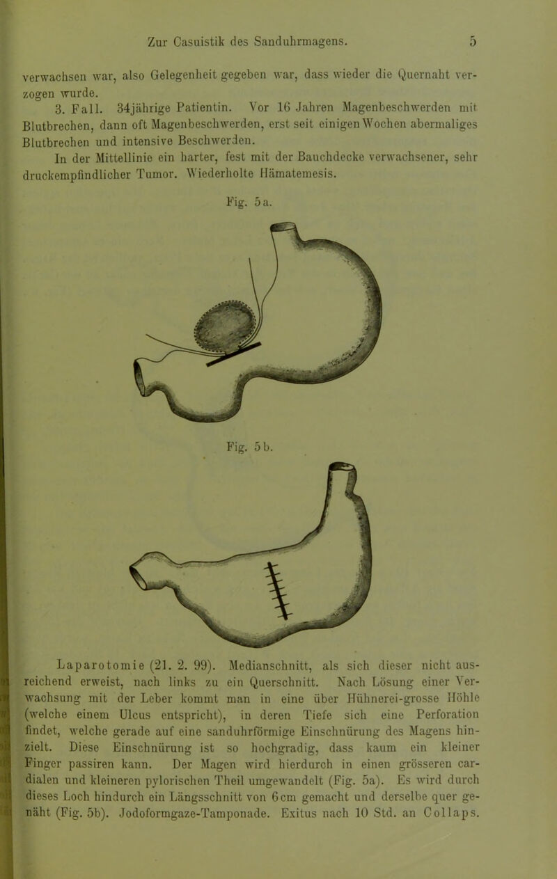 verwachsen war, also Gelegenheit gegeben war, dass wieder die Quernaht ver- zogen wurde. 3. Fall. 34jährige Patientin. Vor 16 Jahren Magenbeschwerden mit Blutbrechen, dann oft Magenbeschwerdun, erst seit einigen Wochen abermaliges Blutbrechen und intensive Beschwerden. In der Mittellinie ein harter, fest mit der Bauchdecke verwachsener, sehr druckempfindlicher Tumor. Wiederholte Mämatemesis. Fig. 5 a. ; i Fig. 5 b. Laparotomie (21. 2. 99). Medianschnitt, als sich dieser nicht aus- reichend erweist, nach links zu ein Querschnitt. Nach Lösung einer Ver- wachsung mit der Leber kommt man in eine über Hühnerei-grosse Höhle (welche einem Ulcus entspricht), in deren Tiefe sich eine Perforation findet, welche gerade auf eine sanduhrförmige Einschnürung des Magens hin- zielt. Diese Einschnürung ist so hochgradig, dass kaum ein kleiner Finger passiren kann. Der Magen wird hierdurch in einen grösseren car- dialen und kleineren pylorischen Theil umgewandelt (Fig. 5a). Es wird durch dieses Loch hindurch ein Längsschnitt von 6cm gemacht und derselbe quer ge- näht (Fig. 5b). Jodoformgaze-Tamponade. Exitus nach 10 Std. an Collaps.