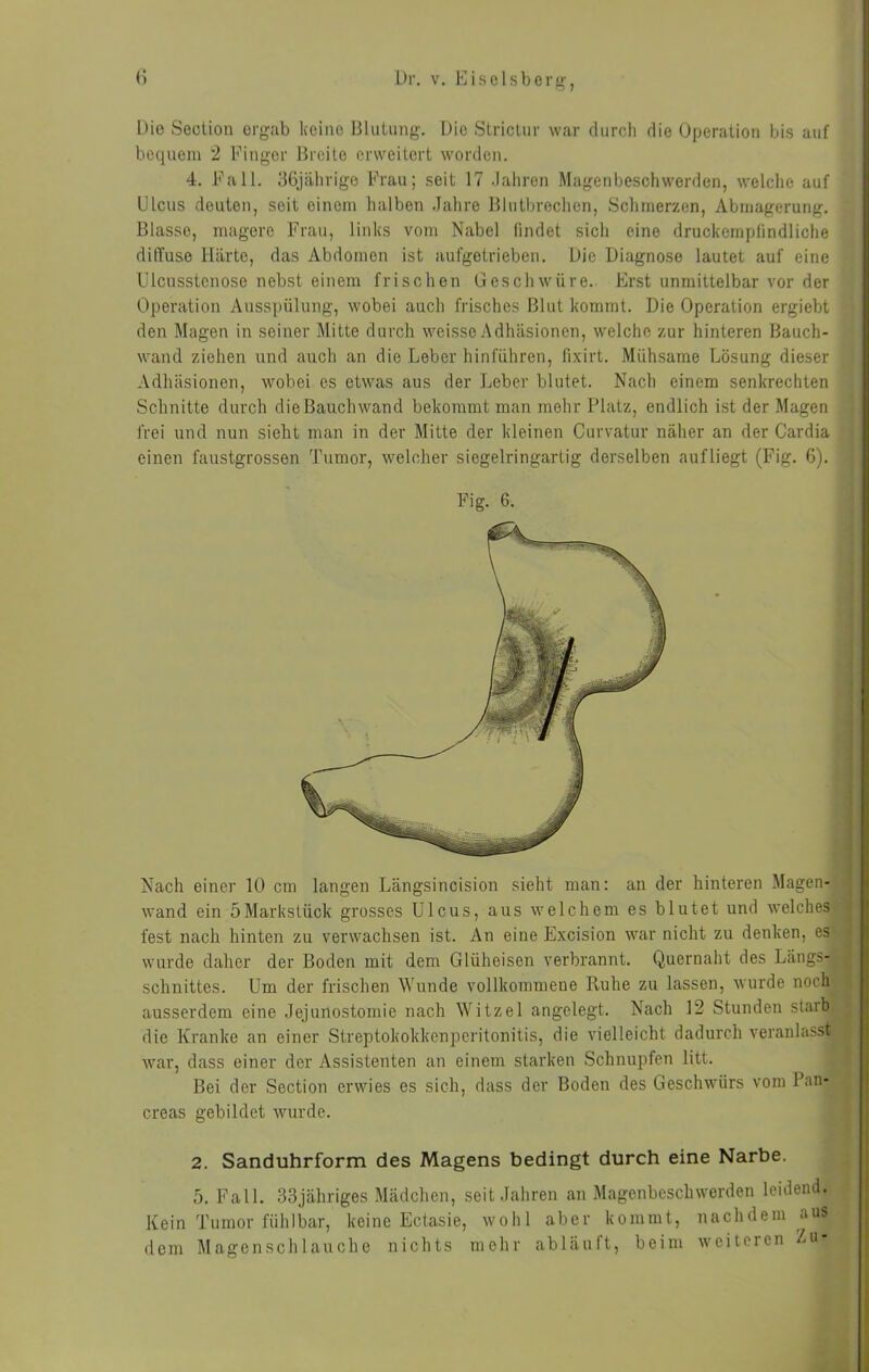 Dio Section orgab keine lilutung. Die Stricliir war diircli die Operation bis auf bequem 2 Finger 15reite erweitert worden. 4. Fall. 36jälirigo Frau; seit 17 .laliren Magenbeschwerden, welche auf Ulcus deuten, seit einem halben .Jahre Blutbreclien, Sclimerzen, Abmagerung. Blasse, magere Frau, links vom Nabel findet sich eine druckempfindliche diffuse Härte, das Abdomen ist aufgotrieben. Die Diagnose lautet auf eine Ulcusstenose nebst einem frischen Geschwüre. Erst unmittelbar vor der Operation Ausspülung, wobei auch frisches Blut kommt. Die Operation ergiebt den Magen in seiner Mitte durch wcissey\dhäsionen, welche zur hinteren Bauch- wand ziehen und auch an die Leber hinführen, fixirt. Mühsame Lösung dieser Adhäsionen, wobei es etwas aus der Leber blutet. Nach einem senkrechten Schnitte durch dieBauchwand bekommt man mehr Platz, endlich ist der Magen frei und nun sieht man in der Mitte der kleinen Curvatur näher an der Cardia einen faustgrossen Tumor, welcher siegelringartig derselben aufliegt (Fig. 6). Nach einer 10 cm langen Längsincision sieht man: an der hinteren Magen- wand ein 5Markstück grosses Ulcus, aus welchem es blutet und welches fest nach hinten zu verwachsen ist. An eine Excision war nicht zu denken, es wurde daher der Boden mit dem Glüheisen verbrannt. Quernaht des Längs- schnittes. Um der frischen Wunde vollkommene Ruhe zu lassen, wurde noch ausserdem eine Jejunostomie nach Witzei angelegt. Nach 12 Stunden starb die Kranke an einer Streptokokkenperitonitis, die vielleicht dadurch veranlasst Avar, dass einer der Assistenten an einem starken Schnupfen litt. Bei der Section erwies es sich, dass der Boden des Geschwürs vom Pan- creas gebildet wurde. 2. Sanduhrform des Magens bedingt durch eine Narbe. 5. Fall. 33jähriges Mädchen, seit Jahren an Magenbeschwerden leidend. Kein Tumor fühlbar, keine Ectasie, wohl aber kommt, nachdem aus dem Magen sch lau che nichts mehr ab läuft, beim weiteren Zu