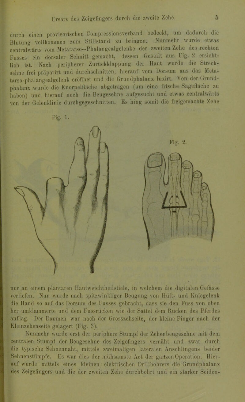 durch einen provisorischen Coinpressionsverband bedeckt, um dadurcli die Blutung vollkommen zum .Stillstand zu bringen. Nunmehr wurde etwas centralwärts vom Metatarso-Phalangealgclenke der zweiten Zehe des rechten Fussos ein dorsaler Schnitt gemacht, dessen Gestalt aus Fig. 2 ersicht- lich ist. Nach peripherer Zurückklappung der Haut wurde die Streck- sehne frei priiparirt und durchschnitten, hierauf vom Dorsum aus das Meta- tarso-phalangealgelcnk erölfnet und die Grundphalanx luxirt. Von der Grund- phalanx wurde die Knorpelfiäche abgetragen (um eine frische Sägefiäche zu haben) und hierauf noch die Beugcschne aufgesucht und etwas centralwärts von der Gelenklinie durchgegeschnilten. Es hing somit die freigemachte Zehe nur an einem plantaren Ilaulweichtheilstiele, in welchem die digitalen Gefässe verliefen. Nun wurde nach spitzwinkliger Beugung von Ilüft- und Kniegelenk die Hand so auf das Dorsum des Fusses gebracht, dass sie den Fuss von oben her umklammerte und dem Fussrücken wie der Sattel dem Kücken des Pferdes auflag. Der Daumen war nach der Grosszehseite, der kleine Finger nach der Klcinzehenseite gelagert (Fig. 3). Nunmehr wurde erst der periphere .Stumpf der Zehenbeugesehne mit dem centralen Stumpf der Beugesehne des Zeigefingers vernäht und zwar durch die typische .Sehnennaht, mittels zweimaligen lateralen Anschlingens beider Sehnenstümpfe. Es war dies der mühsamste Act der gailzenOperation. Hier- auf wurde mittels eines kleinen elektrischen Drillbohrers die Grundphalanx des Zeigefingers und die der zweiten Zehe durchbohrt und ein starker Seiden- Fig. 1.