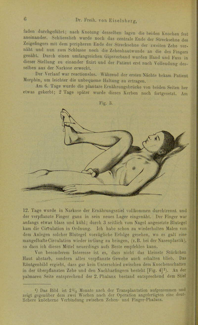 ” iJi'- Froili. von Eiselsherg, riulen iliu-chgcfiilirL; nach Knotnng desselben lagen die beiden Kriocdien fest aneinander. Schliesslich wurde noch das centrale Ende der Strecksehne des Zeigefingers mit dem peripheren Ende der Strecksehne der zweiten Zehe ver- näht lind mm zum Schlüsse noch die Zehenhautwunde an die des Fingers genäht. Durch einen umfangreichen Gipsverband wurden Hand und Fuss in dieser Stellung zu einander fixirt und der Patient erst nach Vollendung des- selben aus der Narkose erweckt. Der Verlauf war reactionslos. Während der ersten Nächte bekam Patient Morphin, um leichter die unbequeme Haltung zu ertragen. Am 6. Tage wurde die plantare F]rnährungsbriicke von beiden Seiten her etwas gekerbt; 2 läge später wurde dieses Kerben noch fortgesetzt. Am Fig. 3. 12. Tage wurde in Narkose der Ernährungsstiel vollkommen durch trennt und der verpflanzte Finger ganz in sein neues Lager eingenäht. Der Finger war anfangs etwas blass und kühl; durch 3 seitlich vom Nagel angesetzte Blutegel kam die Cirbulation in Ordnung. Ich habe schon zu wiederholten Malen von dem Anlegen solcher Blutegel vorzügliche Erfolge gesehen, wo es galt eine mangelhafte Circulation wieder in Gang zu bringen, (z. B. bei der Nasenplastik), so dass ich dieses Mittel neuerdings aufs Beste empfehlen kann. Von besonderem Interesse ist es, dass nicht das kleinste Stückchen Haut abstarb, sondern alles verpflanzte Gewebe auch erhalten blieb. Das Röntgenbild ergiebt, dass gar kein Unterschied zwischen dem Knochenschatten in der überpflanzten Zehe und den Nachbarfingern besteht [Fig. 4]^). An der palmaren Seite entsprechend der 2. Phalanx bestand entsprechend dem Stiel Das Bild ist 2^2 Monate nach der Transplantation aufgenommen und zeigt gegenüber dem zwei Wochen nach der Operation angefertigten eine deut- lichere knöcherne Verbindung zwischen Zehen- und Finger-Phalanx.