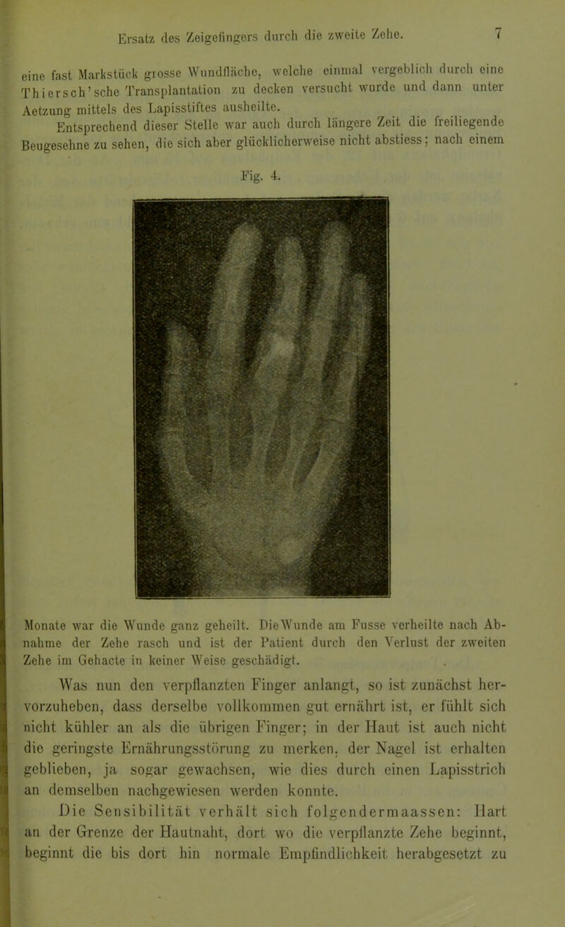 eine fast Markstück grosse Wiindflcächc, welclie einmal vergeblich durch eine Th iersch’sehe Transplantation zu decken versucht wurde und dann unter Aotzung mittels des Lapisstiftes ausheilte. Entsprechend dieser Stelle war auch durch Längere Zeit die freiliegende Beugesehne zu sehen, die sich aber glücklicherweise nicht abstiess; nach einem Fig. 4. Monate war die Wunde ganz geheilt. DieWunde am Fiisse verheilte nach Ab- nahme der Zehe rasch und ist der Patient durch den Verlust der zweiten Zehe im Gehacte in keiner Weise geschädigt. Was nun den verpflanzten Finger anlangt, so ist zunächst her- vorzuheben, dass derselbe vollkommen gut ernährt ist, er fühlt sich '«I nicht kühler an als die übrigen Finger; in der Haut ist auch nicht h die geringste Ernährungsstörung zu merken, der Nagel ist erhalten geblieben, ja sogar gew'achsen, wie dies durch einen Lapisstrich s an demselben nachgewiesen werden konnte. Die Sensibilität verhält sich folgendermaassen: Hart I: an der Grenze der Hautnaht, dort wo die verpflanzte Zehe beginnt, beginnt die bis dort hin normale Empfindlichkeit herabgesetzt zu