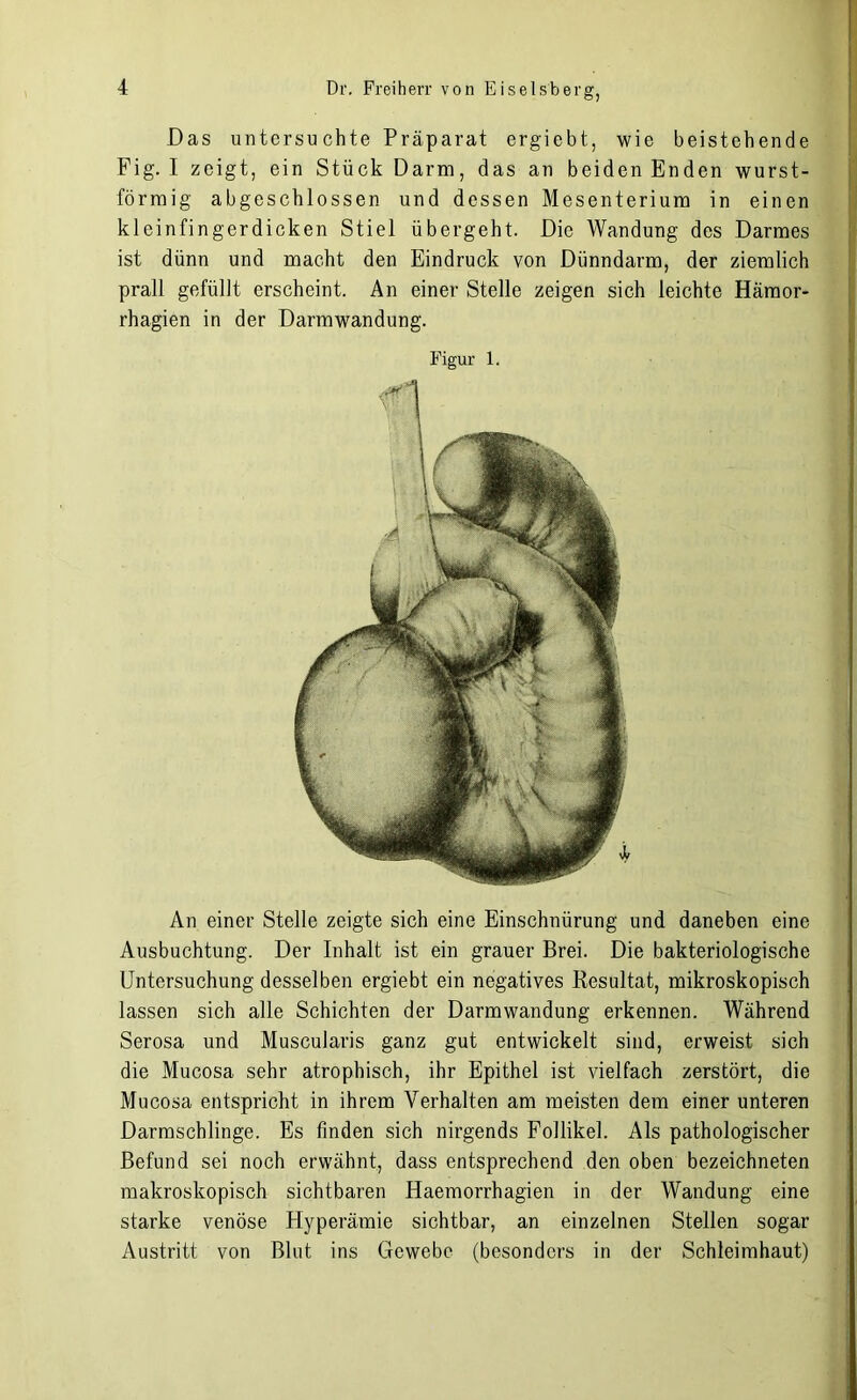 Das untersuchte Präparat ergiebt, wie beistehende Fig. I zeigt, ein Stück Darm, das an beiden Enden wurst- förmig abgeschlossen und dessen Mesenterium in einen kleinfingerdicken Stiel übergeht. Die Wandung des Darmes ist dünn und macht den Eindruck von Dünndarm, der ziemlich prall gefüllt erscheint. An einer Stelle zeigen sich leichte Hämor- rhagien in der Darmwandung. Figur 1. An einer Stelle zeigte sich eine Einschnürung und daneben eine Ausbuchtung. Der Inhalt ist ein grauer Brei. Die bakteriologische Untersuchung desselben ergiebt ein negatives Resultat, mikroskopisch lassen sich alle Schichten der Darmwandung erkennen. Während Serosa und Muscularis ganz gut entwickelt sind, erweist sich die Mucosa sehr atrophisch, ihr Epithel ist vielfach zerstört, die Mucosa entspricht in ihrem Verhalten am meisten dem einer unteren Darmschlinge. Es finden sich nirgends Follikel. Als pathologischer Befund sei noch erwähnt, dass entsprechend den oben bezeichneten makroskopisch sichtbaren Haemorrhagien in der Wandung eine starke venöse Hyperämie sichtbar, an einzelnen Stellen sogar Austritt von Blut ins Gewebe (besonders in der Schleimhaut)