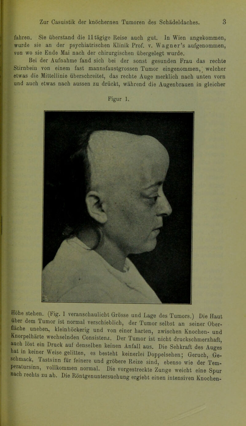 fahren. Sie überstand die 11 tägige Reise auch gut. In Wien angekommen, wurde sie an der psychiatrischen Klinik Prof. v. Wagner’s aufgenommen, von wo sie Ende Mai nach der chirurgischen übergelegt wurde. Bei der Aufnahme fand sich bei der sonst gesunden Frau das rechte Stirnbein von einem fast mannsfaustgrossen Tumor eingenommen, welcher etwas die Mittellinie überschreitet, das rechte Auge merklich nach unten vorn und auch etwas nach aussen zu drückt, während die Augenbrauen in gleicher Figur 1. Hohe stehen. (Fig. 1 veranschaulicht Grösse und Lage des Tumors.) Die Haut über dem Tumor ist normal verschieblich, der Tumor selbst an seiner Ober- fläche unebeo, kleinhöckerig und von einer harten, zwischen Knochen- und Knorpelhärte wechselnden Consistenz. Der Tumor ist nicht druckschmerzhaft, auch löst ein Druck auf denselben keinen Anfall aus. Die Sehkraft des Auges hat in keiner Weise gelitten, es besteht keinerlei Doppolsehen; Geruch, Ge- schmack, Tastsinn für feinere und gröbere Reize sind, ebenso wie der Tem- peratursinn, vollkommen normal. Die vorgestreckte Zunge weicht eine Spur nach rechts zu ab. Die Röntgenuntersuchung ergiebt einen intensiven Knochen-