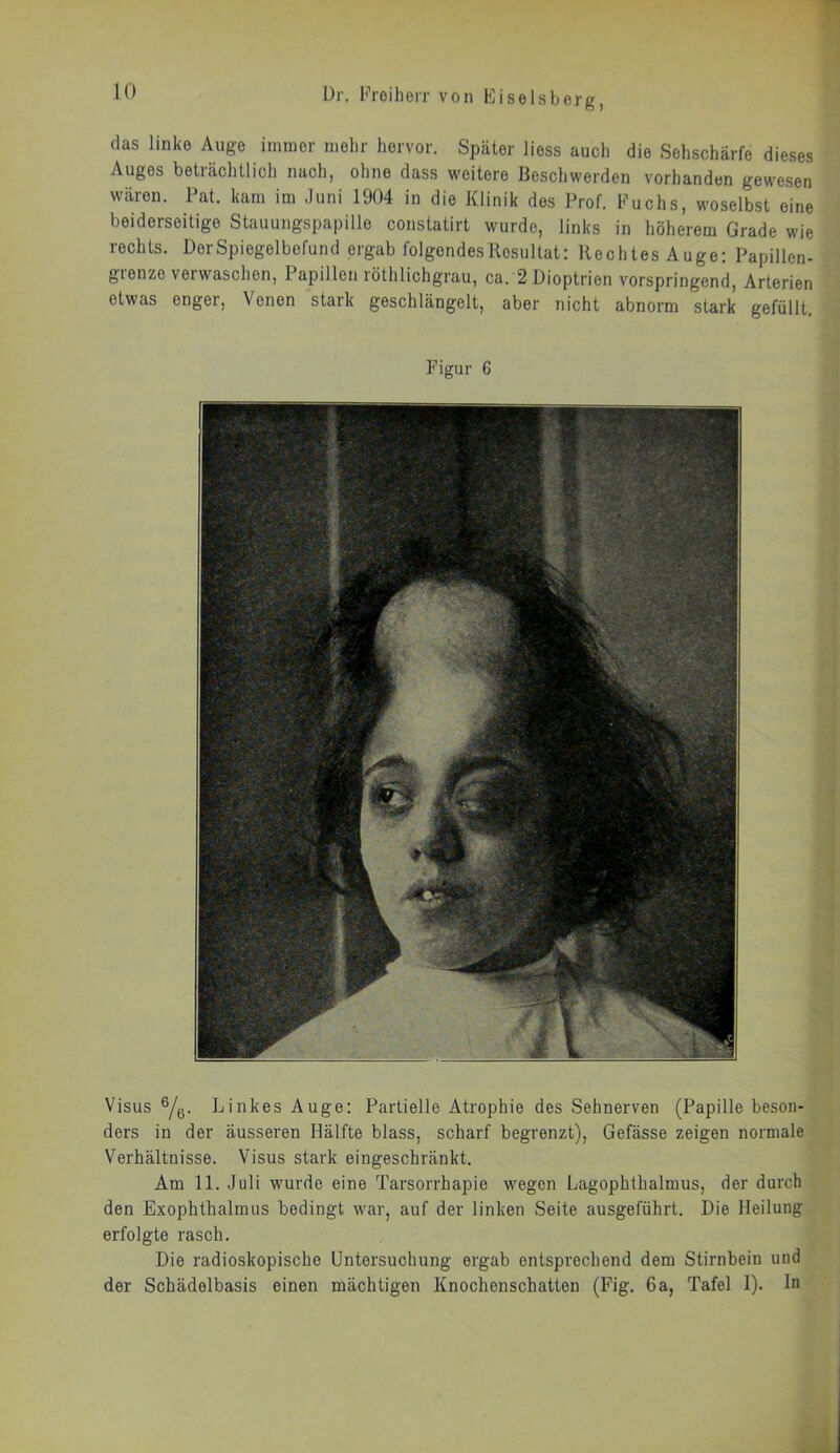 das linke Auge immer mehr hervor. Später liess auch die Sehschärfe dieses Auges beträchtlich nach, ohne dass weitere Beschwerden vorhanden gewesen wären. Pat. kam im Juni 1904 in die Klinik des Prof. Fuchs, woselbst eine beiderseitige Stauungspapille constatirt wurde, links in höherem Grade wie rechts. DerSpiegelbefund ergab folgendes Resultat: Rechtes Auge: Papillen- gionze vei waschen, 1 apillon löthlichgrau, ca. 2 Dioptrien vorspringend, Arterien etwas enger, Venen stark geschlängelt, aber nicht abnorm stark gefüllt. Figur 6 Visus 6/6. Linkes Auge: Partielle Atrophie des Sehnerven (Papille beson- ders in der äusseren Hälfte blass, scharf begrenzt), Gefässe zeigen normale Verhältnisse. Visus stark eingeschränkt. Am 11. Juli wurde eine Tarsorrhapie wegen Lagophthalmus, der durch den Exophthalmus bedingt war, auf der linken Seite ausgeführt. Die Heilung erfolgte rasch. Die radioskopische Untersuchung ergab entsprechend dem Stirnbein und der Schädelbasis einen mächtigen Knochenschatten (Fig. 6a, Tafel I). ln