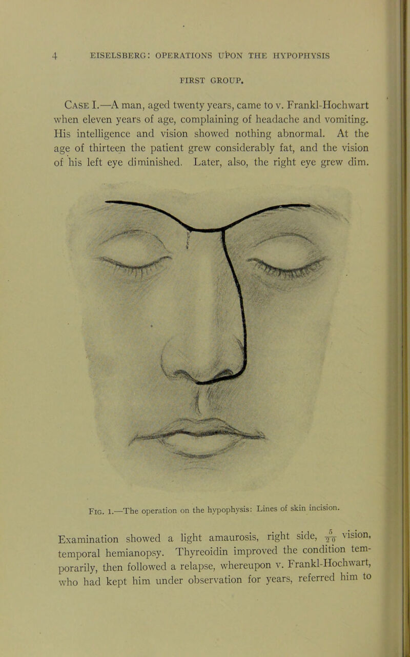 FIRST GROUP. Case I.—A man, aged twenty years, came to v. Frankl-Hochwart when eleven years of age, complaining of headache and vomiting. His intelligence and vision showed nothing abnormal. At the age of thirteen the patient grew considerably fat, and the vision of his left eye diminished. Later, also, the right eye grew dim. Fig. 1.—The operation on the hypophysis: Lines of skin incision. Examination showed a light amaurosis, right side, Jy vlslon’ temporal hemianopsy. Thyreoidin improved the condition tem- porarily, then followed a relapse, whereupon v. Frankl-Hochwart, who had kept him under observation for years, referred him to
