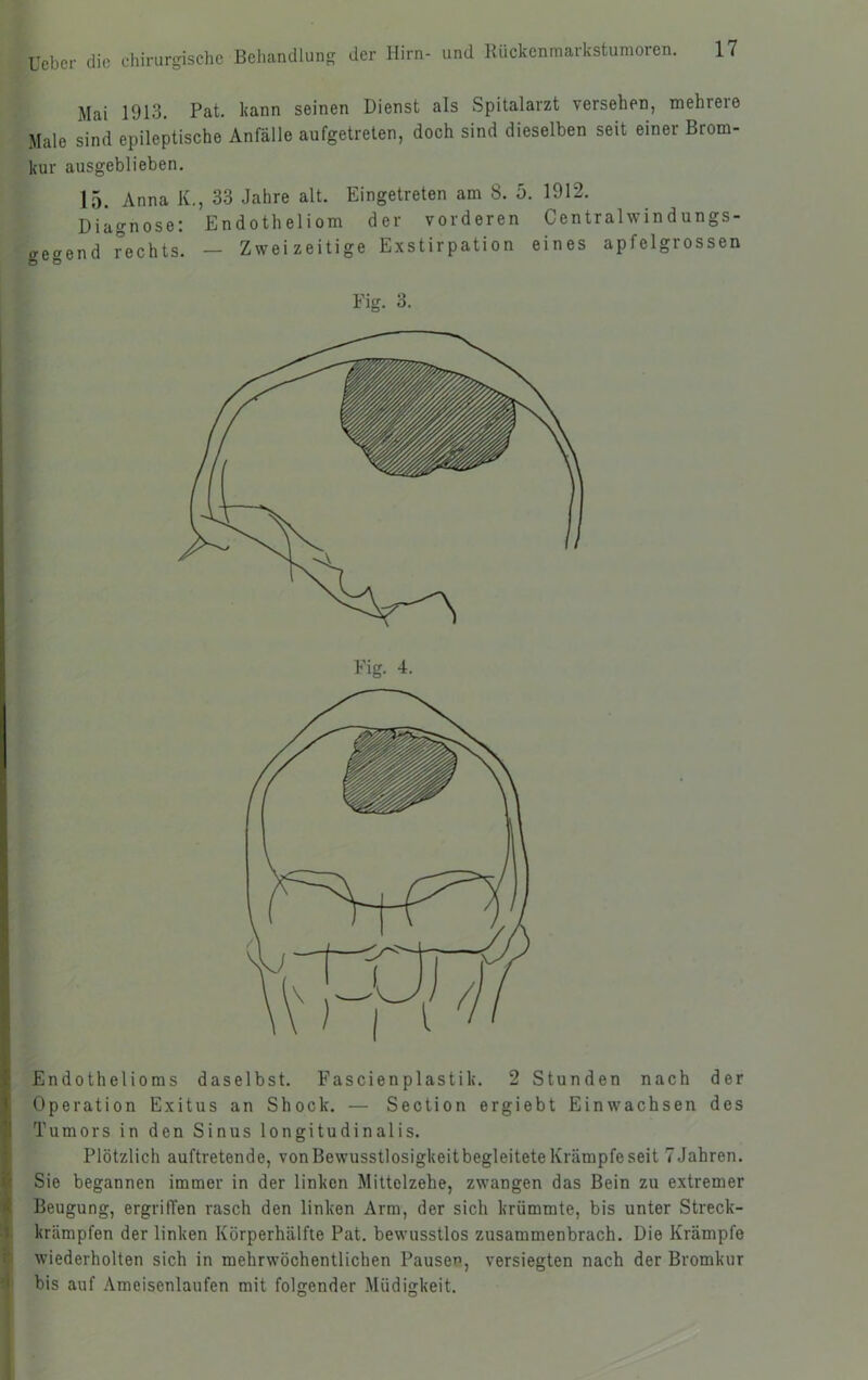 Mai 1913. Pät. kann seinen Dienst als Spitalarzt versehen, mehreie Male sind epileptische Anfälle aufgetrelen, doch sind dieselben seit einer Brom- kur ausgeblieben. 15. Anna K., 33 Jahre alt. Eingetreten am 8. 5 Diagnose; Endotheliom dei vorderen gegend rechts. — Zweizeitige Exstirpation 1912. Centralwindun eines apfelgros gs- sen Fig. 3. Fig. 4. Endothelioms daselbst. Fascienplastik. 2 Stunden nach der Operation Exitus an Shock. — Seotion ergiebt Einwachsen des Tumors in den Sinus longitudinalis. Plötzlich auftretende, von Bewusstlosigkeit begleitete Krämpfe seit 7 Jahren. Sie begannen immer in der linken Mittolzehe, zwangen das Bein zu extremer Beugung, ergriffen rasch den linken Arm, der sich krümmte, bis unter Streck- I krärapfen der linken Körperhälfte Pat. bewusstlos zusammenbrach. Die Krämpfe wiederholten sich in mehrwöchentlichen Pausen, versiegten nach der Bromkur bis auf Ameisenlaufen mit folgender Müdigkeit.