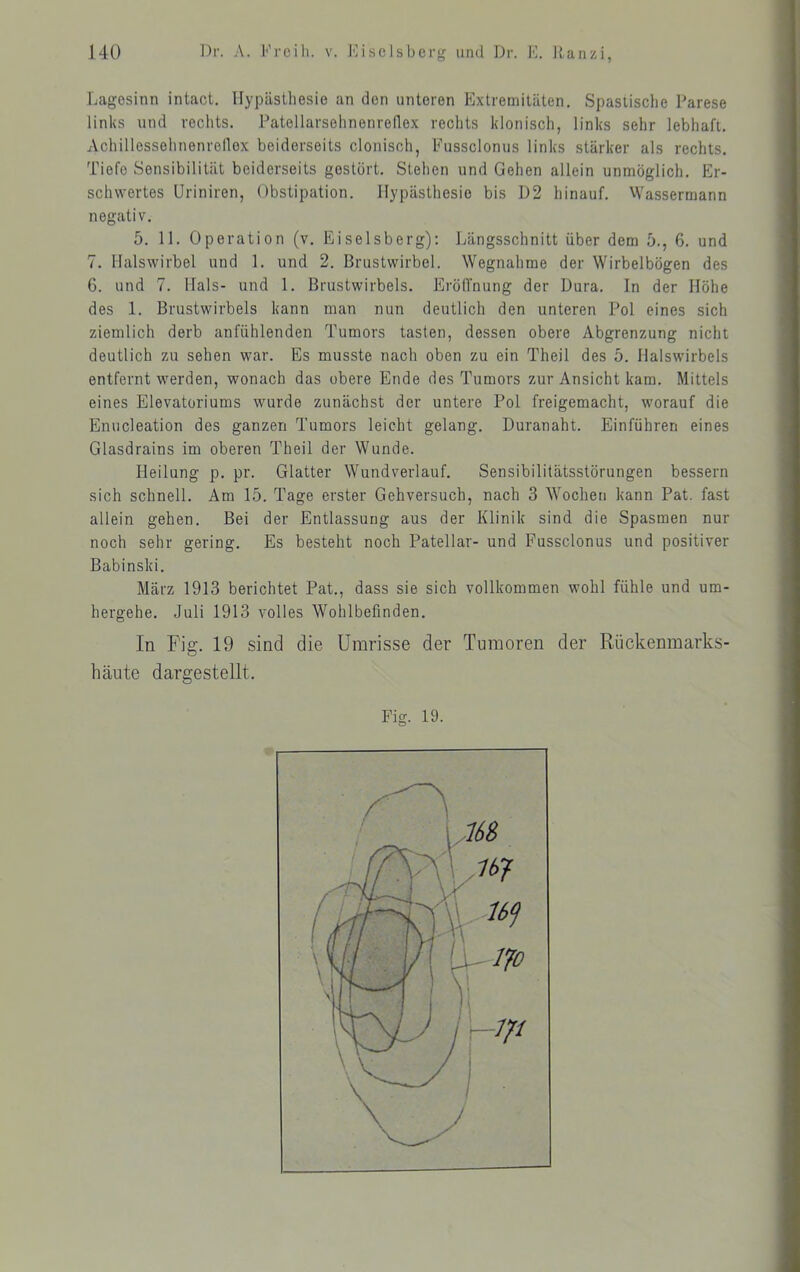 Lagosinn intact. llypästhesie an den unteren Extremitäten. Spastische Parese links und veclits. Patellarsehnenreflex rechts klonisch, links sehr lebhaft. Achillessehnenrellex beiderseits clonisch, Fussclonus links stärker als rechts. Tiefe Sensibilität beiderseits gestört. Stehen und Gehen allein unmöglich. Er- schwertes üriniren, Obstipation. llypästhesie bis D2 hinauf. Wassermann negativ. 5. 11. Operation (v. Eiseisberg): Längsschnitt über dem 5., 6. und 7. Halswirbel und 1. und 2. Brustwirbel. Wegnahme der Wirbelbögen des 6. und 7. Hals- und 1. Brustwirbels. ErölTnung der Dura. In der Höhe des 1. Brustwirbels kann man mm deutlich den unteren Pol eines sich ziemlich derb anfühlenden Tumors tasten, dessen obere Abgrenzung nicht deutlich zu sehen war. Es musste nach oben zu ein Theil des 5. Halswirbels entfernt werden, wonach das obere Ende des Tumors zur Ansicht kam. Mittels eines Elevatoriums wurde zunächst der untere Pol freigemacht, worauf die Enucleation des ganzen Tumors leicht gelang. Duranaht. Einführen eines Glasdrains im oberen Theil der Wunde. Heilung p. pr. Glatter Wundverlauf. Sensibilitätsstörungen bessern sich schnell. Am 15. Tage erster Gehversuch, nach 3 Wochen kann Pat. fast allein gehen. Bei der Entlassung aus der Klinik sind die Spasmen nur noch sehr gering. Es besteht noch Patellar- und Fussclonus und positiver Babinski. März 1913 berichtet Pat., dass sie sich vollkommen wohl fühle und um- hergehe. Juli 1913 volles Wohlbefinden. In Fig. 19 sind die Umrisse der Tumoren der Rückenmarks- häute dargestellt. Fig. 19.