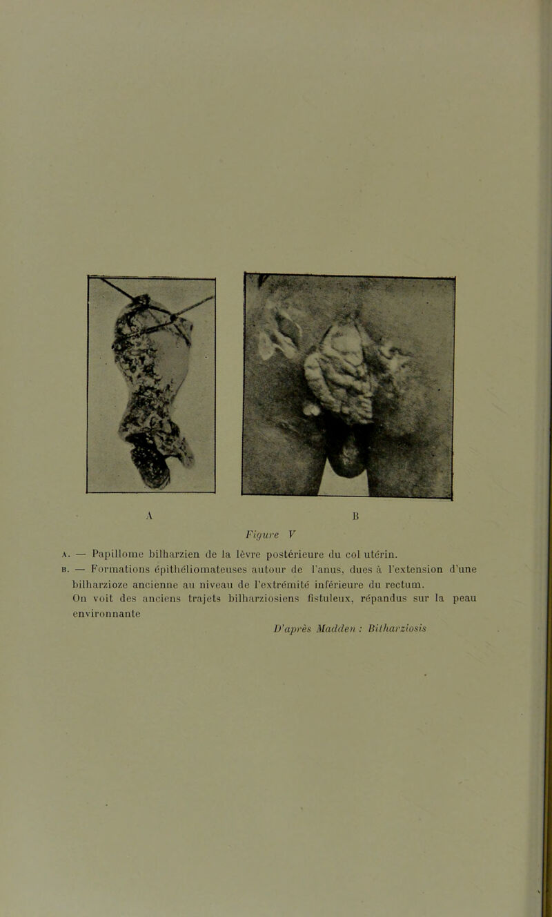 A B Figure V a. — Papillome bilharzien de la lèvre postérieure du col utérin. b. — Formations épithéliomateuses autour de l’anus, dues à l’extension d’une bilharzioze ancienne au niveau de l’extrémité inférieure du rectum. On voit des anciens trajets bilharziosiens fistuleux, répandus sur la peau environnante D’après Madclen : Bilharziosis s