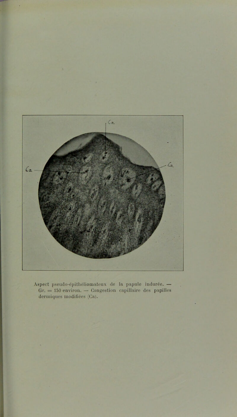 \ Aspect pseudü-épitliélioniateiix de la papule indurée. — Gr. = 150 environ. — Congestion capillaire des papilles dermiques modifiées (Ca).