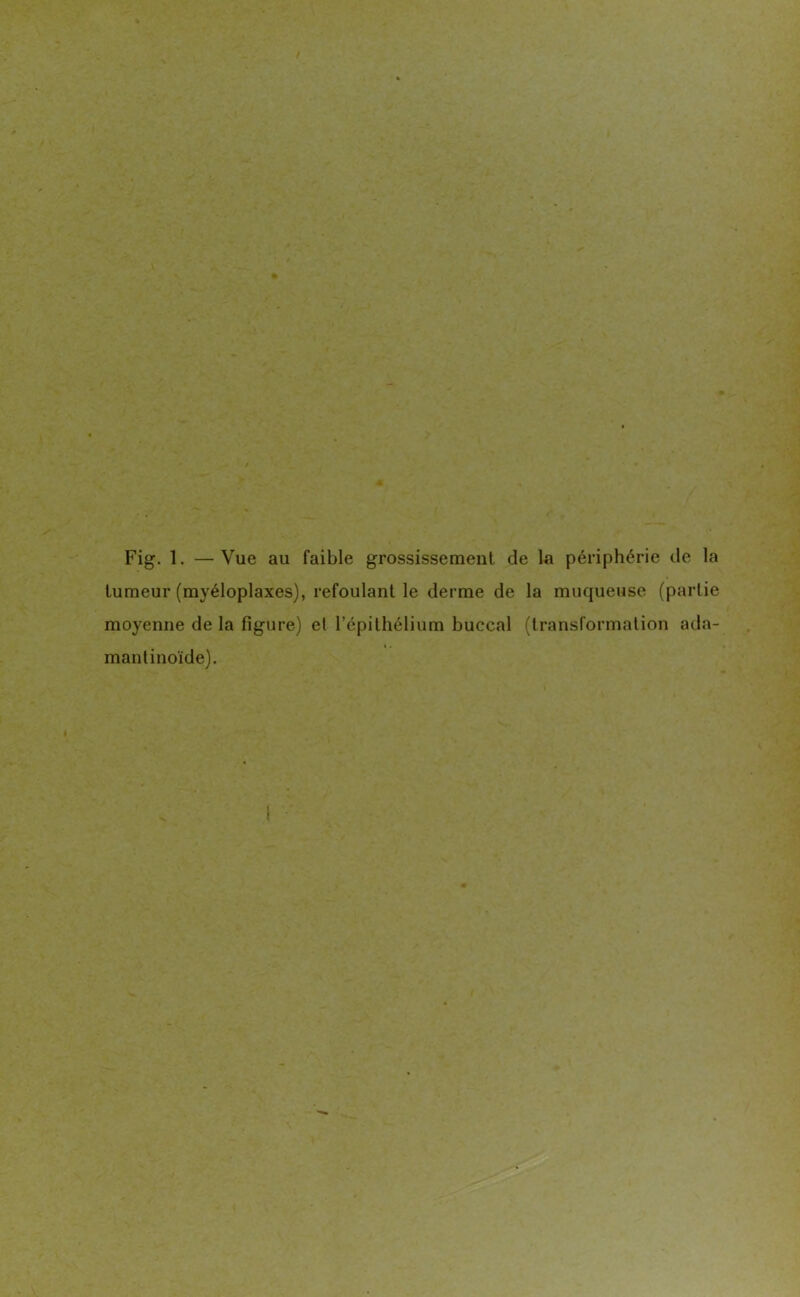 tumeur (myéloplaxes), refoulant le derme de la muqueuse (partie moyenne delà figure) et l’épithélium buccal (transformation ada- mantinoïde).