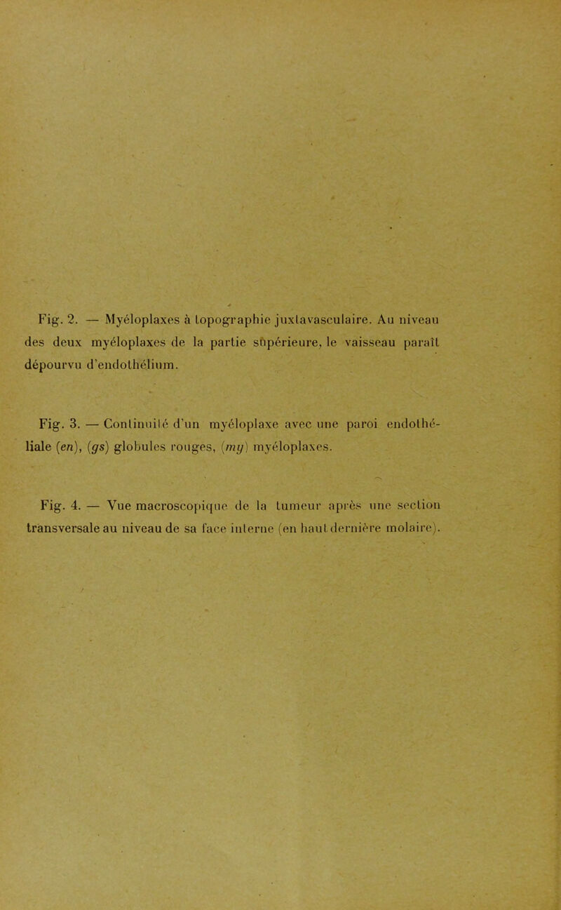 des deux myéloplaxes de la partie supérieure, le vaisseau paraît dépourvu d’endothélium. Fig. 3. — Continuité d’un myéloplaxe avec une paroi endothé- liale (en), (gs) globules rouges, (my) myéloplaxes. • —* Fig. 4. — Vue macroscopique de la tumeur après une section transversale au niveau de sa l’ace interne (en haut dernière molaire).