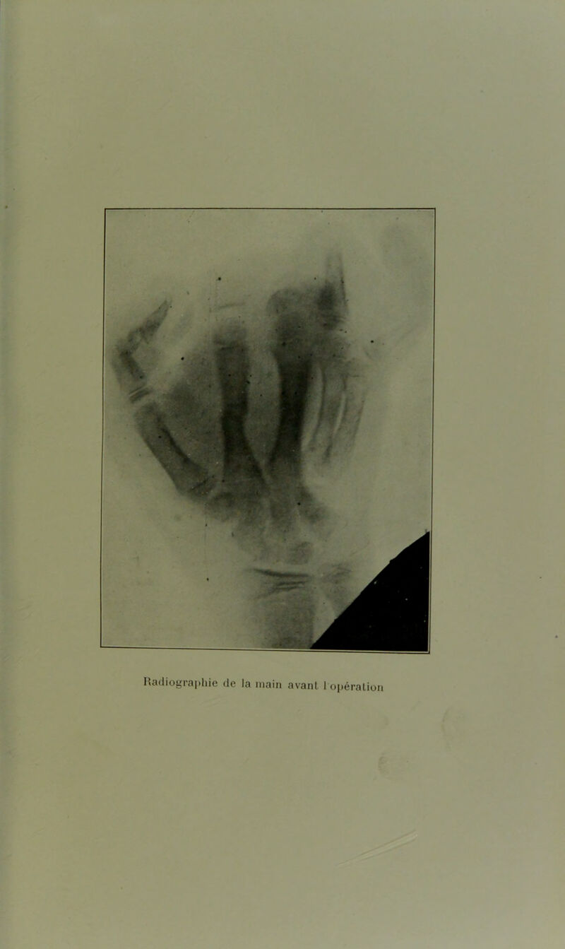 Radiographie de la main avant I opération