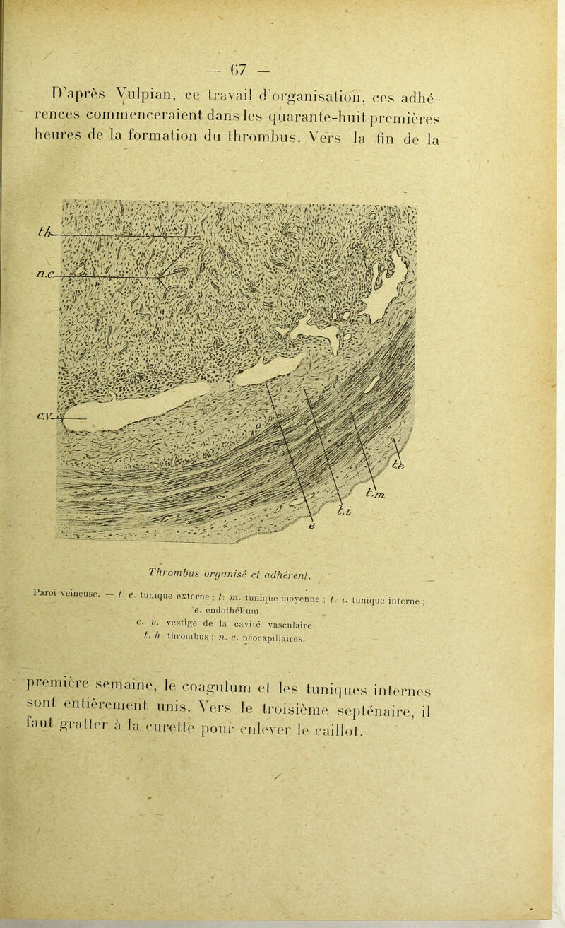 D après Vulpian, cc travail d’organisation, ces adhé- rences commenceraient dans les quarante-huit premières heures de la formation du thrombus. Vers la fin de la Thrombus organisé et adhérent. l’arm veineuse. - l. e. tunique externe ; /, m. tunique moyenne ; t. i. tunique interne e. endothélium. c. v. vestige de la cavité vasculaire. t. h. thrombus ; n. c. ncocapillaircs. première semaine, le coagnlum et les tuniques internes sont entièrement unis. Vers le troisième septénaire, il faut gratter à la miroite pour enlever le caillot.