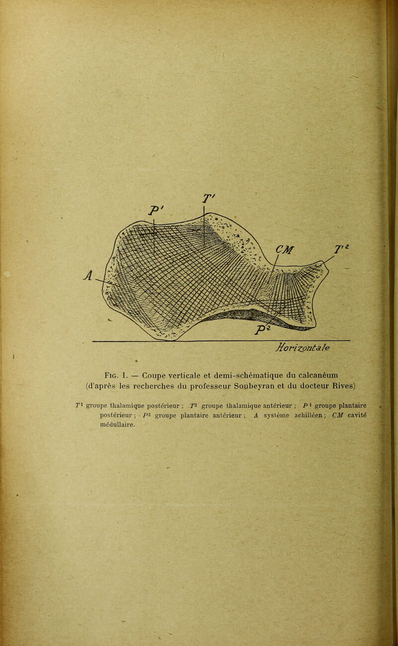 J{oHzontsle Fig. 1. — Coupe verticale et demi-schématique du calcanéum (d’après les recherches du professeur Soubeyran et du docteur Rives) r* groupe thalamique postérieur ; groupe tlialamique antérieur ; P ' groupe plantaire postérieur; groupe plantaire antérieur; A système achillcen ; CM cavité médullaire. 4 -.1