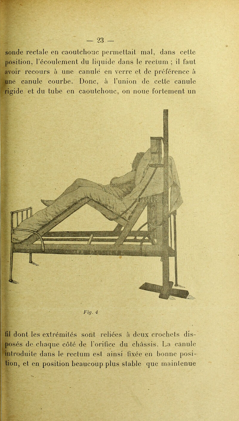 sonde rectale en caoutchouc permettait mal, dans cette position, l’écoulement du liquide dans le rectum ; il faut avoir recours à une canulé en verre et de préférence à une canule courbe. Donc, à l’union de cette canule rigide et du tube en caoutchouc, on noue fortement un Fig. 4 fd dont les extrémités sont reliées à deux crochets dis- posés de chaque côté de l’orifice du châssis. La canule I introduite dans le rectum est ainsi fixée en bonne posi- j tion, et en position beaucoup plus stable que maintenue