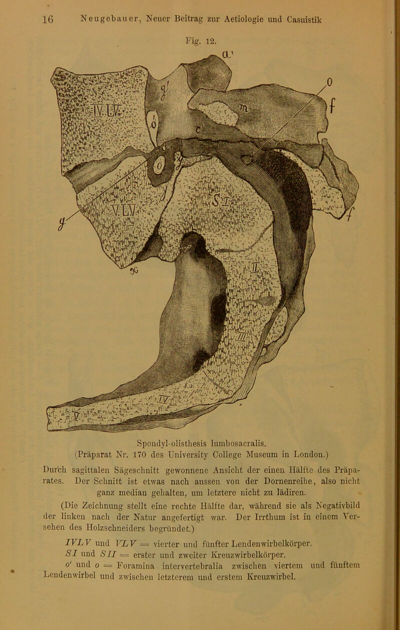 mm pfeife Äfeii ^Ä-ö^Ä' :ua *? l ' ■•.. WWF Spondyl-olisthesis lumbosacralis. (Präparat Nr. 170 des University College Museum in London.) Durch sagittalen Sägeschnitt gewonnene Ansicht der einen Hallte des Präpa- rates. Der Schnitt ist etwas nach aussen von der Dornenreihe, also nicht ganz median gehalten, um letztere nicht zu lädiren. (Die Zeichnung stellt eine rechte Hälfte dar, während sie als Negativbild der linken nach der Natur angefertigt war. Der Irrthum ist in einem Ver- sehen des Holzschneiders begründet.) IVLV und VLV = vierter und fünfter Lendenwirbelkörper. SI und SII = erster und zweiter Kreuz wirbelkörper. o‘ und o = Foramina intervertebralia zwischen viertem und fünftem Lendenwirbel und zwischen letzterem und erstem Kreuzwirbel.