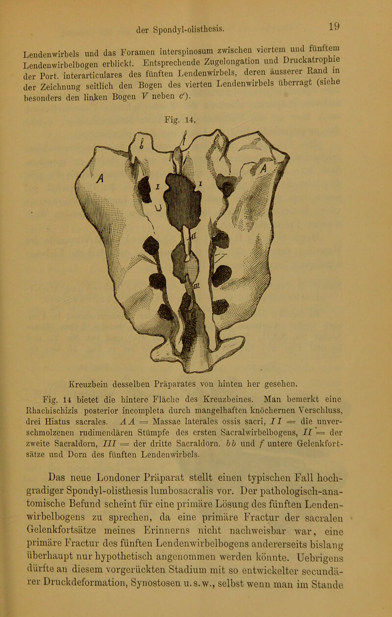 Lendenwirbels und das Foramen interspinosum zwischen viertem und fünftem Lendenwirbelbogen erblickt. Entsprechende Zugelongation und Druckatrophie der Port interarticulares des fünften Lendenwirbels, deren äusserer Rand in der Zeichnung seitlich den Bogen des vierten Lendenwirbels überragt (siehe besonders den linken Bogen V neben c‘). Fig. 14. Kreuzbein desselben Präparates von hinten her gesehen. Fig. 14 bietet die hintere Fläche des Kreuzbeines. Man bemerkt eine Bhachischizis posterior incompleta durch mangelhaften knöchernen Verschluss, drei Hiatus sacrales. AA = Massae laterales ossis sacri, II = die unver- schmolzenen rudimendären Stümpfe des ersten Saeralwirbelbogeus, II = der zweite Sacraldorn, III = der dritte Sacraldorn. bb und f untere Gelenkfort- sätze und Dorn des fünften Lendenwirbels. Das neue Londoner Präparat stellt einen typischen Fall hoch- gradiger Spondyl-olisthesis lumbosacralis vor. Der pathologisch-ana- tomische Befund scheint für eine primäre Lösung des fünften Lenden- wirbelbogens zu sprechen, da eine primäre Fractur der sacralen Gelenkfortsätze meines Erinnorns nicht nachweisbar war, eine primäre Fractur des fünften Londenwirbelbogens andererseits bislang überhaupt nur hypothetisch angenommen werden könnte. Uebrigens dürfte an diesem vorgerückten Stadium mit so entwickelter secundä- rer Druckdeformation, Synostosen u.s.w., selbst wenn man im Stande