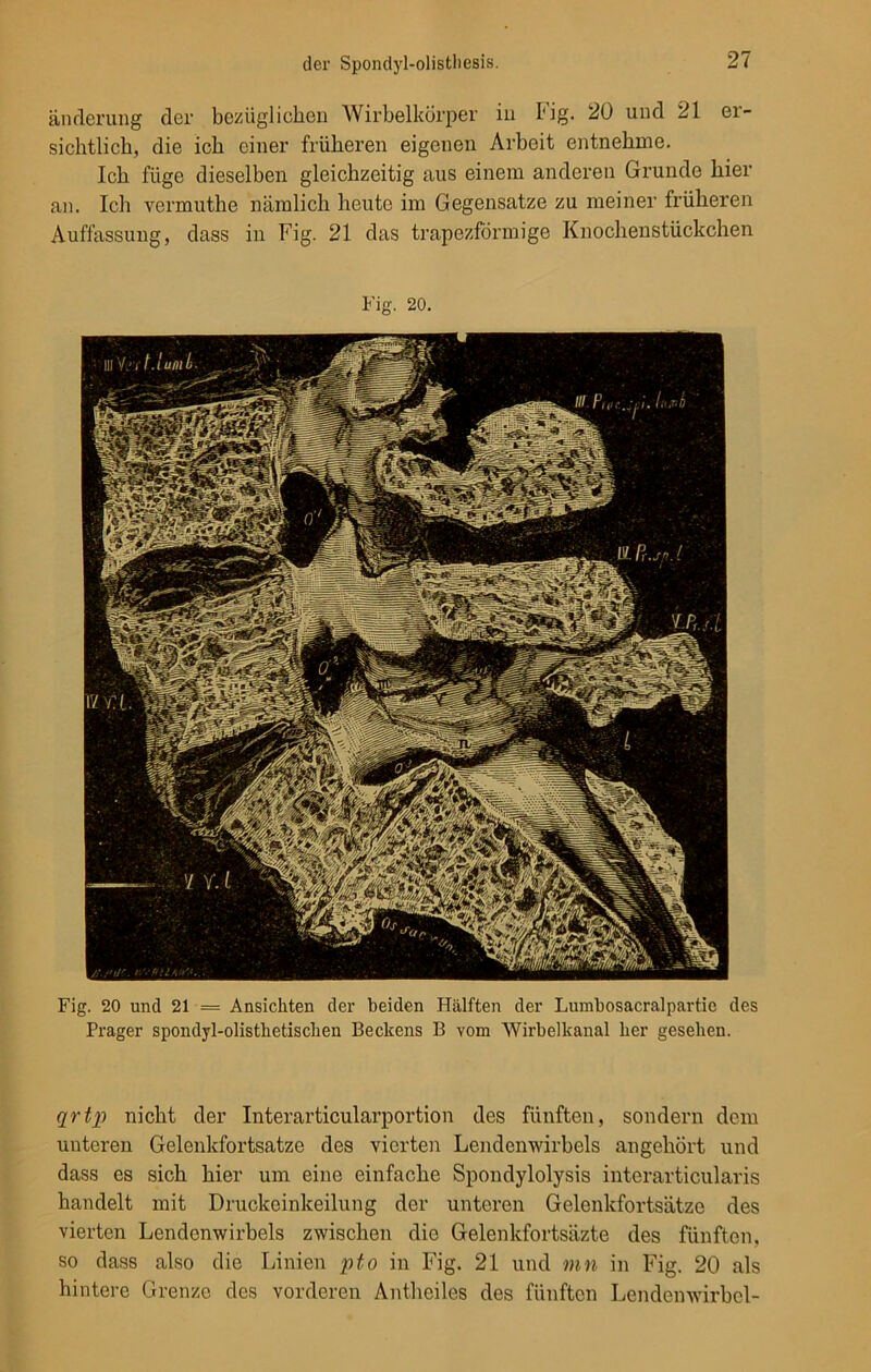 änderung der bezüglichen Wirbelkörper in Fig. 20 und 21 er- sichtlich, die ich einer früheren eigenen Arbeit entnehme. Ich füge dieselben gleichzeitig aus einem anderen Grunde hier an. Ich vermuthe nämlich heute im Gegensätze zu meiner früheren Auffassung, dass in Fig. 21 das trapezförmige Knochenstückchen Fig. 20. Fig. 20 und 21 = Ansichten der beiden Hälften der Lumbosacralpartie des Prager spondyl-olisthetischen Beckens B vom Wirbelkanal her gesehen. qrtp nicht der Interarticularportion des fünften, sondern dem unteren Gelenkfortsatze des vierten Lendenwirbels angehört und dass es sich hier um eine einfache Spondylolysis interarticularis handelt mit Druckeinkeilung der unteren Gelenkfortsätze des vierten Lendenwirbels zwischen die Gelenkfortsäzte des fünften, so dass also die Linien pto in Fig. 21 und mn in Fig. 20 als hintere Grenze des vorderen Antheiles des fünften Lendenwirbel-