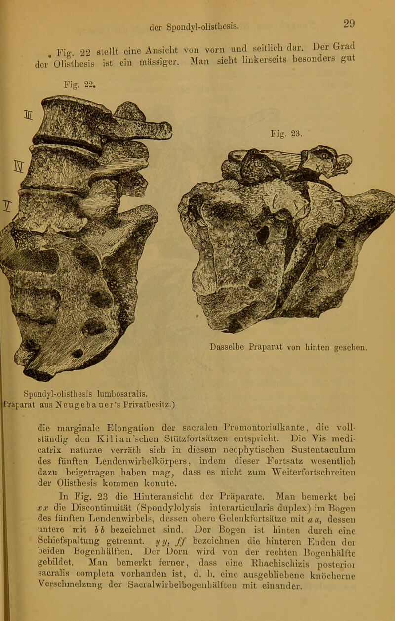 jp,V 22 stellt eine Ansicht von vorn und seitlich dar. Der Grad der* Olisthesis ist ein massiger. Man sieht linkerseits besonders gut Sponclyl-olisthesis lumhosaralis. Präparat aus Neugeba uer’s Privatbesitz.) die marginale Elongation der sacralen Promontorialkante, die voll- ständig den Kilian’schen Stützfortsätzen entspricht. Die Vis medi- catrix naturae verräth sich in diesem neophytischeu Sustentaculum des fünften Lendenwirbelkörpers, indem dieser Fortsatz wesentlich dazu beigetragen haben mag, dass es nicht zum Weiterfortsclireiten der Olisthesis kommen konnte. In Fig, 23 die Hinteransicht der Präparate. Man bemerkt bei xx die Discontinuität (Spondylolysis interarticularis duplex) im Bogen des fünften Lendenwirbels, dessen obere Gelenkfortsätze mit an, dessen untere mit bb bezeichnet sind. Der Bogen ist hinten durch eine Schiefspaltung getrennt, yy, ff bezeichnen die hinteren Enden der beiden Bogenhälfteu. Der Dorn wird von der rechten Bogenhälfte gebildet. Man bemerkt ferner, dass eine Rhachischizis posterior sacralis complcta vorhanden ist, d. h. eine ausgebliebene knöcherne Verschmelzung der Sacralwirbelbogenhülften mit einander.