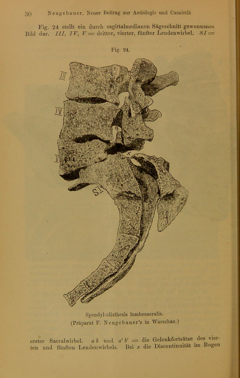 Fig. 24 stellt ein durch sagittalmedianen Sägeschnitt gewonnenes Bild dar. III, IV, V — dritter, vierter, fünfter Lendenwirbel. SI = Fig. 24. Spondyl-olistkesis lumbosacralis. (Präparat F. Neugcbauer’s in Warschau.) erster Sacralwirbel. ab und a1 V = die Gelenkfortsätze des viel ten und fünften Lendenwirbels. Bei x die Discontinuität un ogen