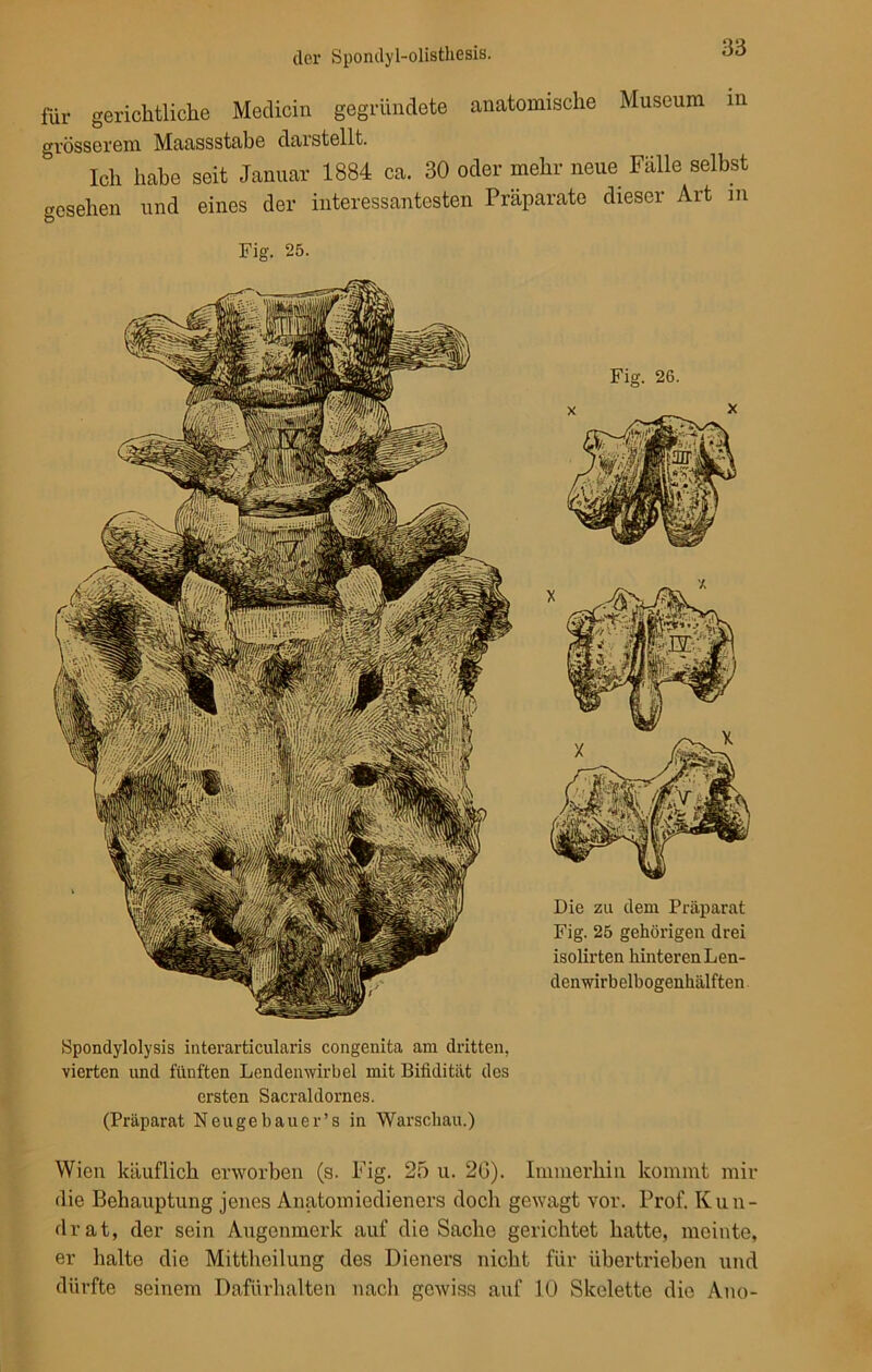 für gerichtliche Meclicin gegründete anatomische Museum m grösserem Maassstabe darstellt. Ich habe seit Januar 1884 ca. 30 oder mehr neue Fälle selbst gesehen und eines der interessantesten Präparate dieser Art m Fig. 25. Fig. 26. Spondylolysis interarticularis congenita am dritten, vierten und fünften Lendenwirbel mit Bifidität des ersten Sacraldornes. (Präparat Neugebauer’s in Warschau.) Wien käuflich erworben (s. Fig. 25 u. 26). Immerhin kommt mir die Behauptung jenes Anatomiedieners doch gewagt vor. Prof. Kun- drat, der sein Augenmerk auf die Sache gerichtet hatte, meinte, er halte die Mittheilung des Dieners nicht für übertrieben und dürfte seinem Dafürhalten nach gewiss auf 10 Skelette die Ano- Die zu dem Präparat Fig. 25 gehörigen drei isolirten hinteren Len- denwirbelbogenhälften