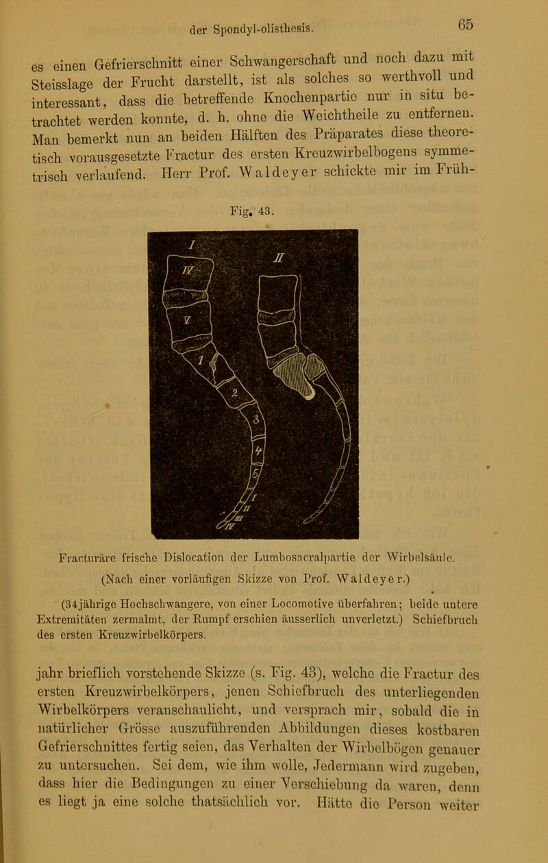 es einen Gefrierschnitt einer Schwangerschaft und noch dazu mit Steisslage der Frucht darstellt, ist als solches so werthvoll und interessant, dass die betreffende Knochenpartie nur in situ be- trachtet werden konnte, d. h. ohne die Weichtheile zu entfernen. Man bemerkt nun an beiden Hälften des Präparates diese theore- tisch vorausgesetzte Fractur des ersten Kreuzwirbelbogens symme- trisch verlaufend. Herr Prof. Waldeyer schickte mir im Früh- Fig. 43. Fracturäve frische Dislocation der Lumbosacralpartie der Wirbelsäule. (Nach einer vorläufigen Skizze von Prof. Waldeyer.) • (34jährige Hochschwangere, von einer Locomotive überfahren; beide untere Extremitäten zermalmt, der Rumpf erschien äusserlich unverletzt.) Schiefbruch des ersten Kreuzwirbelkörpers. jahr brieflich vorstehende Skizze (s. Fig. 43), welche die Fractur des ersten Kreuzwirbelkörpers, jenen Schiefbruch des unterliegenden Wirbelkörpers veranschaulicht, und versprach mir, sobald die in natürlicher Grösse auszuführenden Abbildungen dieses kostbaren Gefrierschnittes fertig seien, das Verhalten der Wirbelbögen genauer zu untersuchen. Sei dem, wie ihm wolle, Jedermann wird zugeben, dass hier die Bedingungen zu einer Verschiebung da waren, denn es liegt ja eine solche thatsiichlich vor. Hätte die Person weiter