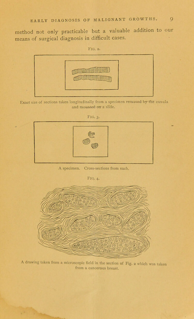 method not only practicable but a valuable addition to our means of surgical diagnosis in difficult cases. Fig. 2. Exact size of sections taken longitudinally from a specimen removed by the canula and mounted oir a slide. Fig. 3. Fig. 4. A drawing taken from a microscopic field in the section of Fig. 2 which was taken from a cancerous breast.