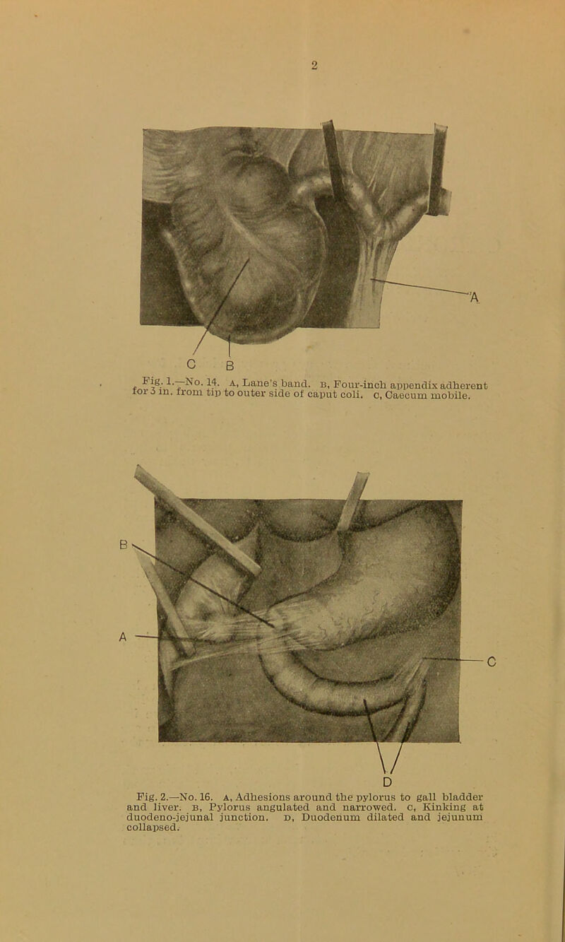 D Fig. 2.—No. 16. a, Adhesions around the pylorus to gall bladder and liver, b, Pylorus angulated and narrowed, c, Kinking at duodeno-jejunal junction, d, Duodenum dilated and jejunum collapsed. c B J?* A» Dane’s band, b, Four-inch appendix adherent ior o in. from tip to outer side of caput coli. c, Caecum mobile.