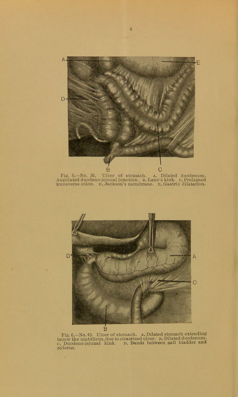 B C Fig. 5,—No. 30, Ulcer of stomach. A, Dilated duodenum, Angulated duodeno-jejunal junction, b, Lane’s kink, c, Prolapsed transverse colon, d„ Jackson’s membrane. e, Gastric dilatation. B Fig. 6,—No. 43. Ulcer of stomach, a. Dilated stomach extending below the umbilicus, due to cicatrized ulcer, b, Dilated duodenum, c, Duodeno-jejunal kink. d. Bands between gall bladder and pylorus.