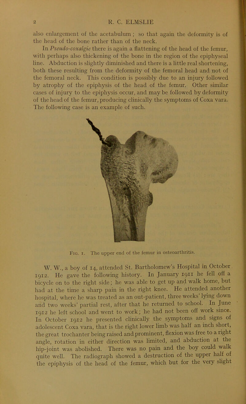 also enlargement of the acetabulum ; so that again the deformity is of the head of the bone rather than of the neck. In Pseudo-coxalgie there is again a flattening of the head of the femur, with perhaps also thickening of the bone in the region of the epiphyseal line. Abduction is slightly diminished and there is a little real shortening, both these resulting from the deformity of the femoral head and not of the femoral neck. This condition is possibly due to an injury followed by atrophy of the epiphysis of the head of the femur. Other similar cases of injury to the epiphysis occur, and maybe followed by deformity of the head of the femur, producing clinically the symptoms of Coxa vara. The following case is an example of such. Fig. i. The upper end of the femur in osteoarthritis. W. W., a boy of 14, attended St. Bartholomew’s Hospital in October 1912. He gave the following history. In January 1911 he fell off a bicycle on to the right side; he was able to get up and walk home, but had at the time a sharp pain in the right knee. He attended another hospital, where he was treated as an out-patient, three weeks lying down and two weeks’ partial rest, after that he returned to school. In June 1912 he left school and went to work; he had not been off work since. In October 1912 he presented clinically the symptoms and signs of adolescent Coxa vara, that is the right lower limb was half an inch short, the great trochanter being raised and prominent, flexion was free to a right angle, rotation in either direction was limited, and abduction at the hip-joint was abolished. There was no pain and the boy could walk quite well. The radiograph showed a destruction of the upper half of the epiphysis of the head of the femur, which but for the very slight