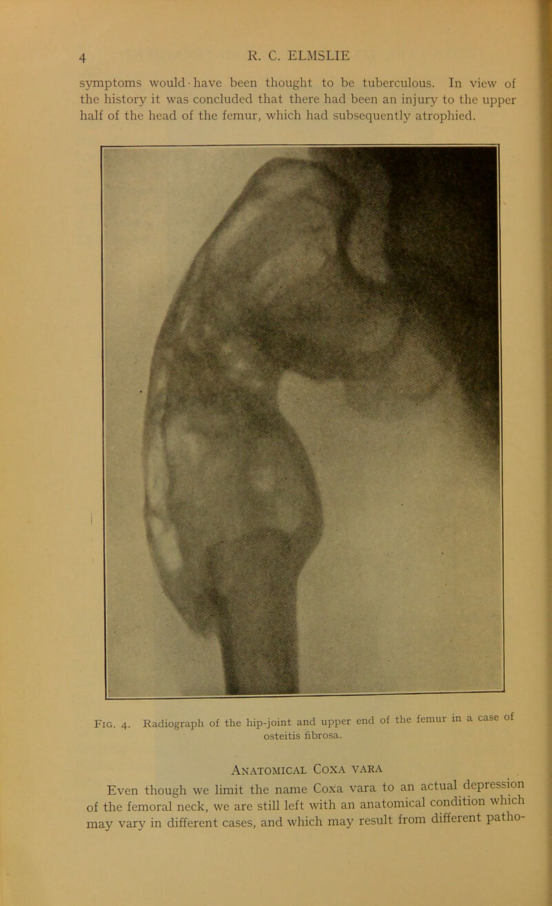 symptoms would have been thought to be tuberculous. In view of the history it was concluded that there had been an injury to the upper half of the head of the femur, which had subsequently atrophied. Fig. 4. Radiograph of the hip-joint and upper end of the femur in a case of osteitis fibrosa. Anatomical Coxa vara Even though we limit the name Coxa vara to an actual depiession of the femoral neck, we are still left with an anatomical condition which may vary in different cases, and which may result from different patho