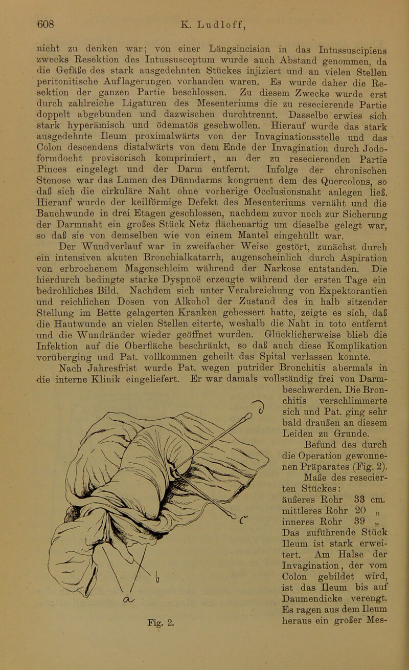 nicht zu denken war; von einer Längsincision in das Intussuscipiens zwecks Resektion des Intussusceptum wurde auch Abstand genommen da die Gefäße des stark ansgedehnten Stückes injiziert und an vielen Stellen peritonitische Auflagerungen vox-handen waren. Es wurde daher die Re- sektion der ganzen Pai-tie beschlossen. Zu diesem Zwecke wurde erst durch zahlreiche Ligaturen des Mesenteriums die zu resecierende Partie doppelt abgebunden und dazwischen durchtrennt. Dasselbe erwies sich stai-k hyperämisch und ödematös geschwollen. Hierauf wurde das stark ausgedehnte Ileuin proximalwärts von der Invaginationsstelle und das Colon descendens distalwärts von dem Ende der Invagination durch Jodo- foi’mdocht provisorisch komprimiert, an der zu resecierenden Partie Pinces eingelegt und der Dann entfernt. Infolge der chronischen Stenose war das Lumen des Dünndarms kongruent dem des Quercolons, so daß sich die cirkuläre Naht ohne vorherige Occlusionsnaht anlegen ließ. Hierauf wurde der keilförmige Defekt des Mesenteriums vernäht und die Bauchwunde in drei Etagen geschlossen, nachdem zuvor noch zur Sichei'ung der Darmnaht ein großes Stück Netz flächenartig um dieselbe gelegt war, so daß sie von demselben wie von einem Mantel eingehüllt war. Der Wund verlauf war in zweifacher Weise gestört, zunächst durch ein intensiven akuten Bronchialkatarrh, augenscheinlich durch Aspiration von erbrochenem Magenschleim während der Narkose entstanden. Die hierdurch bedingte starke Dyspnoe erzeugte während der ersten Tage ein bedrohliches Bild. Nachdem sich unter Verabreichung von Expektorantien und reichlichen Dosen von Alkohol der Zustand des in halb sitzender Stellung im Bette gelagerten Kranken gebessert hatte, zeigte es sich, daß die Hautwunde an vielen Stellen eiterte, weshalb die Naht in toto entfernt und die Wundränder wieder geöffnet wurden. Glücklicherweise blieb die Infektion auf die Obei’fläche beschränkt, so daß auch diese Komplikation voi’überging und Pat. vollkommen geheilt das Spital verlassen konnte. Nach Jahresfi'ist wurde Pat. wegen putrider Bronchitis abei'mals in die interne Klinik eingeliefert. Er war damals vollständig frei von Darm- beschwerden. Die Bron- chitis verschlimmerte sich und Pat. ging sehr bald draußen an diesem Leiden zu Grunde. Befund des durch die Operation gewonne- nen Präparates (Eig. 2). Maße des resecier- ten Stückes: äußeres Rohr 33 cm. mittleres Rohr 20 „ inneres Rohr 39 „ Das zuführende Stück Ileiun ist stai*k erwei- tert. Am Halse der Invagination, der vom Colon gebildet wird, ist das Ileuin bis auf Daumendicke verengt. Es ragen aus dem Ileuin heraus ein großer Mes-