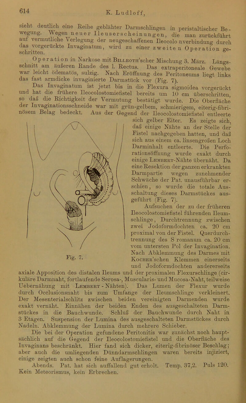 sieht deutlich eine Reihe geblähter Darmschlingen in peristaltischer Be- wegung. ®gen neuer Heuser schein ungen, die man zurückführt auf vermutliche Verlegung der neugeschaffenen Ileocolo nverbindung durch das vorgerückte Invaginatum, wird zu einer zweiten Operation ge- schritten. 1 & Operation in Narkose mit BiLLROTii’scher Mischung 3. März. Längs- schnitt. am äußeren Rande des 1. Rectus. Das extraperitoneale Gewebe war leicht ödematös, sulzig. Nach Eröffnung des Peritoneums liegt links das fast armdicke invaginierte Darmstiick vor (Fig. 7). Das Invaginatum ist jetzt bis in die Flexura sigmoidea vorgerückt und hat die friiheie Ileocolostomiefistel bereits um 10 cm überschritten, so daß die Richtigkeit der Vermutung bestätigt wurde. Die Oberfläche dei Invaginationsschneide war mit grün-gelbem, schmierigem, eiterig-fibri- nösem Belag bedeckt. Aus der Gegend der Ileocolostomiefistel entleerte sich gelber Eiter. Es zeigte sich, daß einige Nähte an der Stelle der Fistel nachgegeben hatten, und daß sich aus einem ca. linsengroßen Loch Darminhalt entleerte. Die Perfo- rationsöffnung wurde exakt durch einige LEMBERT-Nähte übernäht. Da eine Resektion der ganzen erkrankten Darmpartie wegen zunehmender Schwäche der Pat. unausführbar er- schien , so wurde die totale Aus- schaltung dieses Darmstückes aus- geführt (Fig. 7). Aufsuchen der zu der früheren Ileocolostomiefistel führenden Ileum- schlinge, Durchtrennung zwischen zwei Jodoformdochten ca. 20 cm proximal von der Fistel. Querdurch- trennung des S romanum ca. 20 cm vom untersten Pol der Invagination. Nach Abklemmung des Darmes mit KocHER’schen Klemmen einerseits und Jodoformdochten andererseits axiale Apposition des distalen Ileums und der proximalen Flexurschlinge (cir- kuläre Darmnaht, fortlaufende Serosa-, Muscularis- und Mucosa-Naht, teilweise Uebernähung mit Lembert - Nähten). Das Lumen der Flexur wurde durch Occlusionsnaht bis zum Umfange der Ileumschlinge verkleinert. Der Mesenterialschlitz zwischen beiden vereinigten Darmenden wurde exakt vernäht. Einnähen der beiden Enden des ausgeschalteten Darm- stückes in die Bauchwunde. Schluß der Bauchwunde durch Naht in 3 Etagen. Suspension der Lumina des ausgeschalteten Darmstückes durch Nadeln. Abklemmung der Lumina durch mehrere Schieber. Die bei der Operation gefundene Peritonitis war zunächst noch haupt- sächlich auf die Gegend der Ileocolostomiefistel und die Oberfläche des Invaginans beschränkt. Hier fand sich dicker, eiterig-fibrinöser Beschlag; aber auch die umliegenden Dünndarmschlingen waren bereits injiziert, einige zeigten auch schon feine Auflagerungen. Abends. Pat. hat sich auffallend gut erholt. Temp. 37,2. Puls 120. Kein Meteorismus, kein Erbrechen.