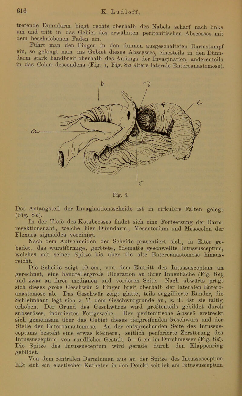 tretende Dünndarm biegt rechts oberhalb des Nabels scharf nach links um und tritt in das Gebiet des erwähnten peritonitischen Abscesses mit dem beschriebenen Faden ein. Führt man den Finger in den dünnen ausgeschalteten Darmstumpf ein, so gelangt man ins Gebiet dieses Abscesses, einesteils in den Dünn- darm stark handbreit oberhalb des Anfangs der Invagination, anderenteils in das Colon descendens (Fig. 7, Fig. 8 a ältere laterale Enteroanastomose). Der Anfangsteil der Invaginationsscheide ist in cirkuläre Falten gelegt (Fig. 8 b). In der Tiefe des Kotabcesses findet sich eine Fortsetzung der Darm- resektionsnaht , welche hier Dünndarm, Mesenterium und Mesocolon der Flexura sigmoidea vereinigt. Nach dem Aufschneiden der Scheide präsentiert sich, in Eiter ge- badet , das wurstförmige, gerötete, ödematös geschwellte Intussusceptum, welches mit seiner Spitze bis über die alte Enteroanastomose hinaus- reicht. Die Scheide zeigt 10 cm, von dem Eintritt des Intussusceptum an gerechnet, eine handtellergroße Ulceration an ihrer Innenfläche (Fig. 8 c), und zwar an ihrer medianen und vorderen Seite. Nach abwärts prägt sich dieses große Geschwür 2 Finger breit oberhalb der lateralen Entero- anastomose ab. Das Geschwür zeigt glatte, teils suggillierte Ränder, die Schleimhaut legt sich z. T. dem Geschwürgrunde an, z. T. ist sie faltig erhoben. Der Grund des Geschwüres wird größtenteils gebildet durch subseröses, induriertes Fettgewebe. Der peritonitische Absceß erstreckt sich gemeinsam über das Gebiet dieses tiefgreifenden Geschwürs und der Stelle der Enteroanastomose. An der entsprechenden Seite des Intussus- ceptums besteht eine etwas kleinere , seitlich perforierte Zerstörung des Intussusceptum von rundlicher Gestalt, 5—6 cm im Durchmesser (Fig. 8 d). Die Spitze des Intussusceptum wird gerade durch den Klappenring gebildet. Von dem centralen Darmlumen aus an der Spitze des Intussusceptum läßt sich ein elastischer Katheter in den Defekt seitlich am Intussusceptum