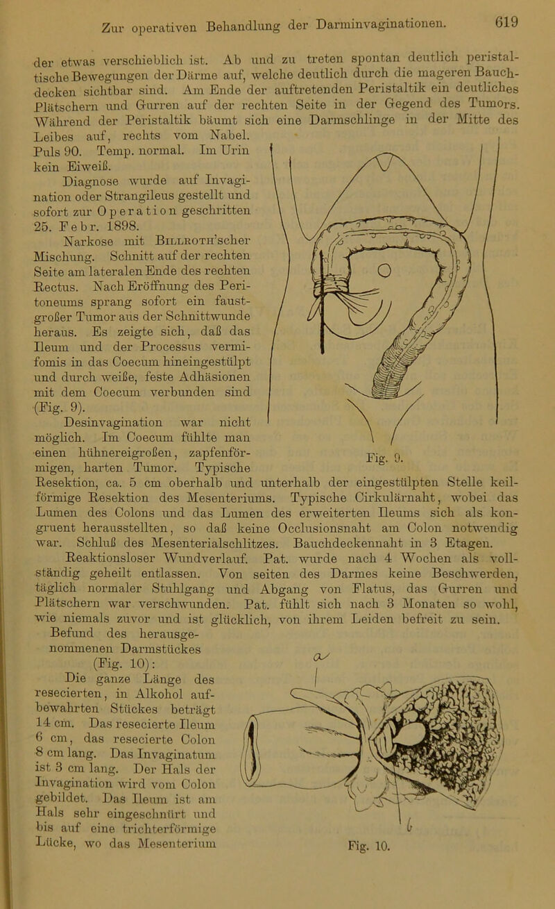 der etwas verschieblich ist. Ab und zu treten spontan deutlich peristal- tische Bewegungen der Därme auf, welche deutlich durch die mageren Bauch- decken sichtbar sind. Am Ende der auftretenden Peristaltik ein deutliches Plätschern und Gurren auf der rechten Seite in der Gegend des Tumors. Während der Peristaltik bäumt sich eine Darmschlinge in der Mitte des Leibes auf, rechts vom Nabel. Puls 90. Temp. normal. Im Urin kein Eiweiß. Diagnose wurde auf Invagi- nation oder Strangileus gestellt und sofort zur Operation geschritten 25. Eebr. 1898. Narkose mit BiLLROTn’scker Mischung. Schnitt auf der rechten Seite am lateralen Ende des rechten Rectus. Nach Eröffnung des Peri- toneums sprang sofort ein faust- großer Tumor aus der Schnittwunde heraus. Es zeigte sich, daß das Ileum und der Processus vermi- fomis in das Coecum hineingestülpt und durch weiße, feste Adhäsionen mit dem Coecum verbunden sind (Fig. 9). Desinvagination war nicht möglich. Im Coecum fühlte man einen hühnereigroßen, zapfenför- migen, harten Tumor. Typische Resektion, ca. 5 cm oberhalb und unterhalb der eingestülpten Stelle keil- förmige Resektion des Mesenteriums. Typische Cirkulärnaht, wobei das Lumen des Colons und das Lumen des erweiterten Ileums sich als kon- gruent herausstellten, so daß keine Occlusionsnaht am Colon notwendig war. Schluß des Mesenterialschlitzes. Bauchdeckennaht in 3 Etagen. Reaktionsloser Wundverlauf. Pat. -wurde nach 4 Wochen als voll- ständig geheilt entlassen. Von seiten des Darmes keine Beschwerden, täglich normaler Stuhlgang und Abgang von Flatus, das Gurren und Plätschern war verschwunden. Pat. fühlt sich nach 3 Monaten so wohl, wie niemals zuvor und ist glücklich, von ihrem Leiden befreit zu sein. Befund des herausge- nommenen Darmstückes (Fig. 10): Die ganze Länge des resecierten, in Alkohol auf- bewahrten Stückes beträgt 14 cm. Das resecierte Ileum 6 cm, das resecierte Colon 8 cm lang. Das Invaginatum ist 3 cm lang. Der Hals der Invagination wird vom Colon gebildet. Das Ileum ist am Hals sehr eingeschnürt und bis auf eine trichterförmige Lücke, wo das Mesenterium OS Fig. 10.