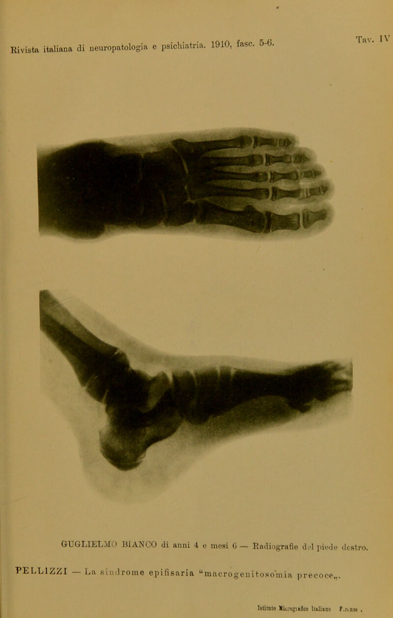 GUGLIELMO ) BIANCO di anni 4 e mesi 0— Radiografie dol piede destro. PE LEI ZZI — La sindrome epifisaria “macrògenitosomia precoce,..