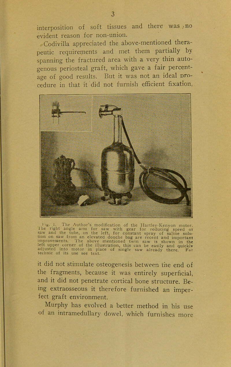 interposition of soft tissues and there was mo evident reason for non-union. Codivilla appreciated the above-mentioned thera- peutic requirements and met them partially by spanning the fractured area with a very thin auto- genous periosteal graft, which gave a fair percent- age of good results. But it was not an ideal Dro- cedure in that it did not furnish efficient fixation, 1’ig. 1. The Author’s modification of the I Iartley-Kenyon motor. 1 he right angle arm for saw with gear for reducing speed oi saw and the tube, on the left, for constant spray of saline solu- tion on saw from an elevated douche bag are recent and important improvements. The above mentioned twin saw is shown in the left upper corner of the illustration, this can be easily and quicklv adjusted into motor in place of single saw already there. For technic of its use see text. it did not stimulate osteogenesis between the end of the fragments, because it was entirely superficial, and it did not penetrate cortical bone structure. Be- ing extraosseous it therefore furnished an imper- fect graft environment. Murphy has evolved a better method in his use of an intramedullary dowel, which furnishes more