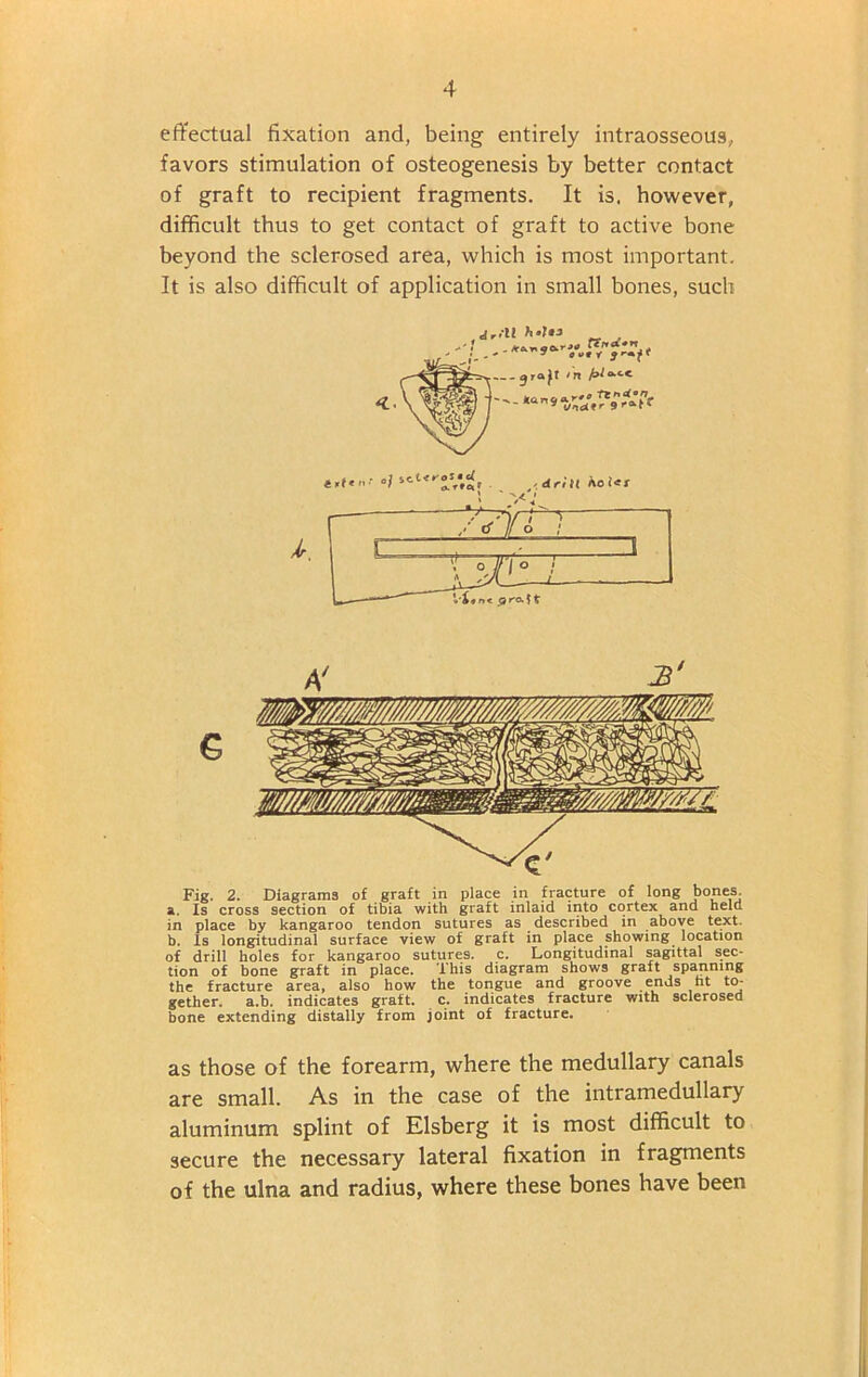 effectual fixation and, being entirely intraosseous,, favors stimulation of osteogenesis by better contact of graft to recipient fragments. It is, however, difficult thus to get contact of graft to active bone beyond the sclerosed area, which is most important. It is also difficult of application in small bones, such Fig. 2. Diagrams of graft in place in fracture of long bones. a. Is cross section of tibia with graft inlaid into cortex and held in place by kangaroo tendon sutures as described in above text. b. Is longitudinal surface view of graft in place showing location of drill holes for kangaroo sutures, c. Longitudinal sagittal sec- tion of bone graft in place. This diagram shows graft spanning the fracture area, also how the tongue and groove ends nt to- gether. a.b. indicates graft, c. indicates fracture with sclerosed bone extending distally from joint of fracture. as those of the forearm, where the medullary canals are small. As in the case of the intramedullary aluminum splint of Elsberg it is most difficult to secure the necessary lateral fixation in fragments of the ulna and radius, where these bones have been G