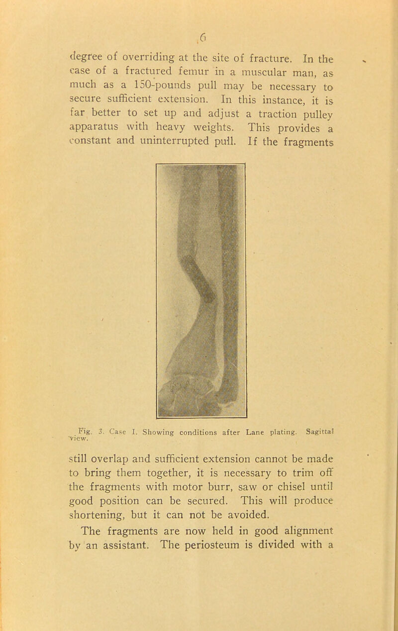 degree of overriding at the site of fracture. In the case of a fractured femur in a muscular man, as much as a 150-pounds pull may be necessary to secure sufficient extension. In this instance, it is far better to set up and adjust a traction pulley apparatus with heavy weights. This provides a constant and uninterrupted pull. If the fragments Fig. 3. Case I. Showing conditions after Lane plating. Sagittal view. still overlap and sufficient extension cannot be made to bring them together, it is necessary to trim off the fragments with motor burr, saw or chisel until good position can be secured. This will produce shortening, but it can not be avoided. The fragments are now held in good alignment by an assistant. The periosteum is divided with a